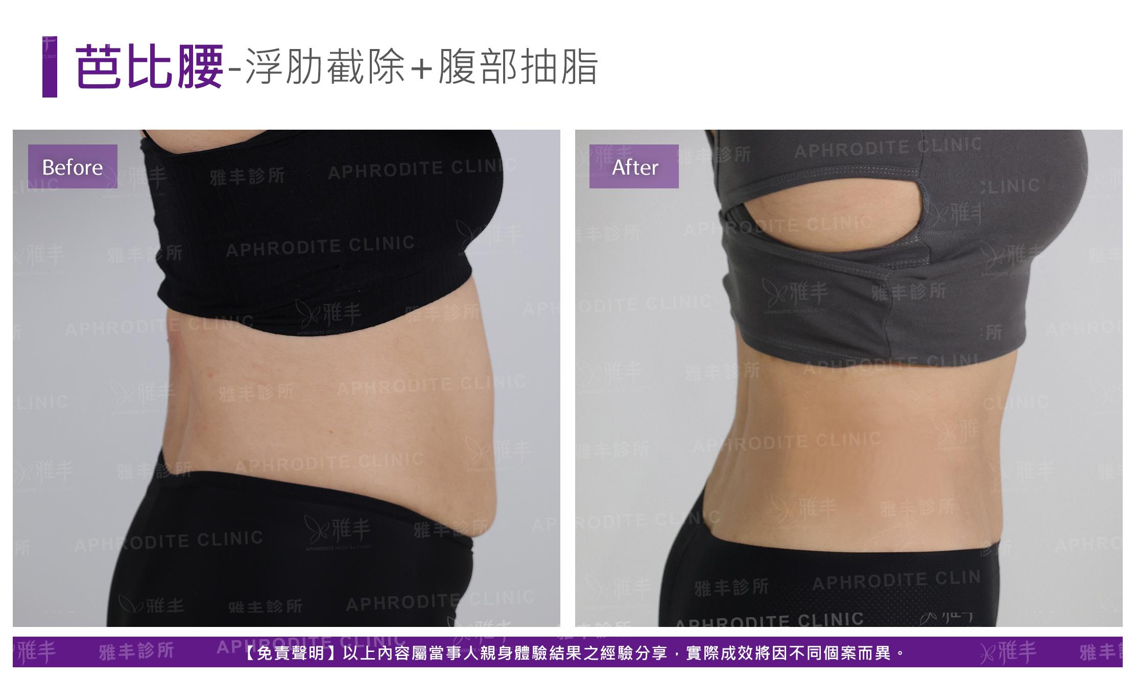 芭比腰-case1-R90.jpg