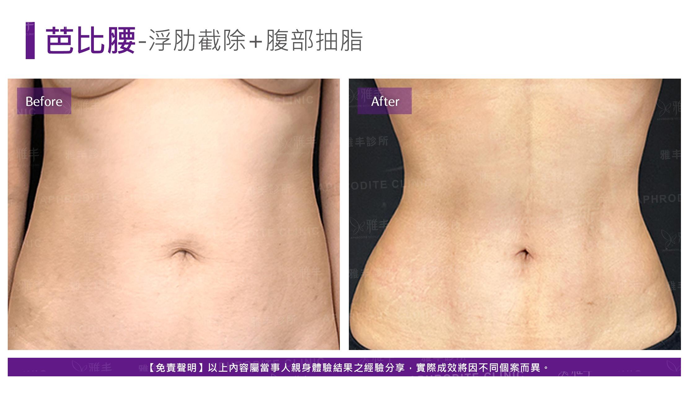 浮肋截除-case3-B.jpg