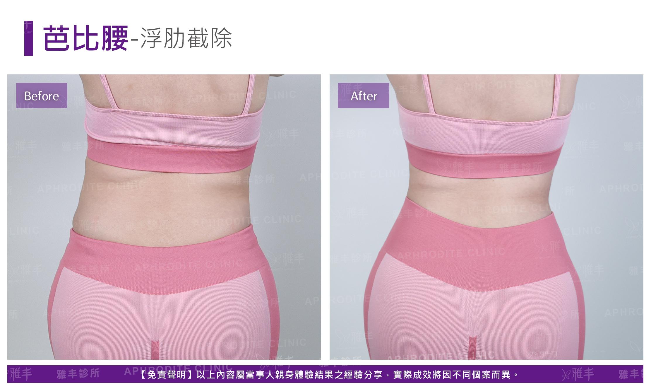 芭比腰-case4-B.jpg