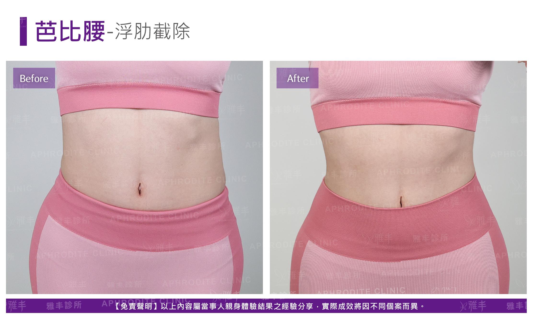 芭比腰-case4-F.jpg