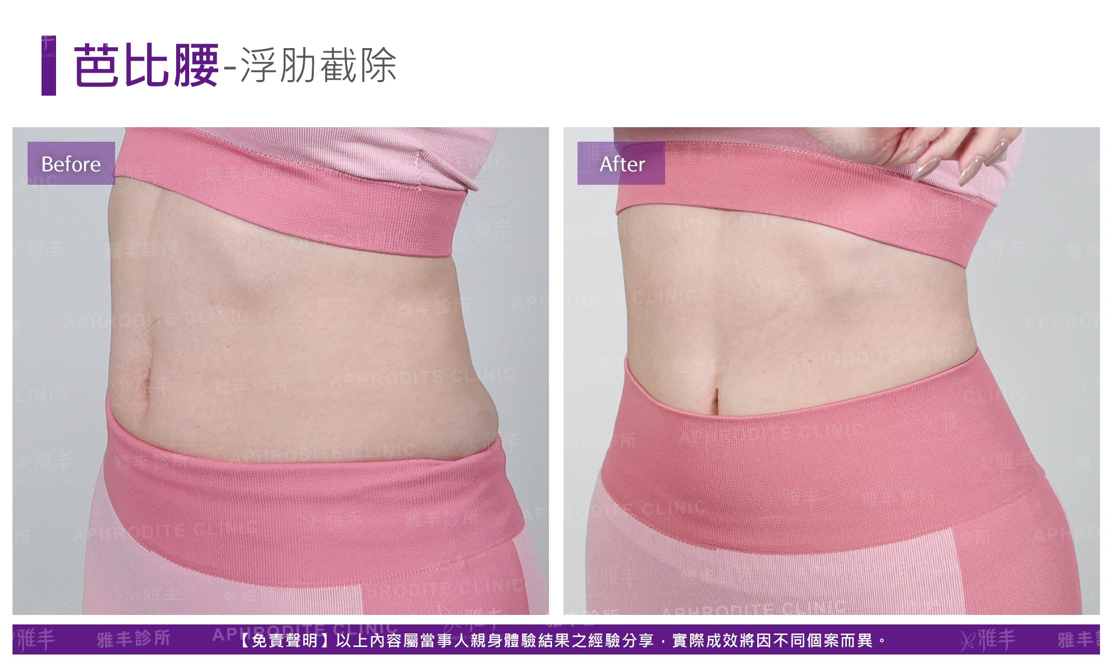 芭比腰-case4-L45.jpg