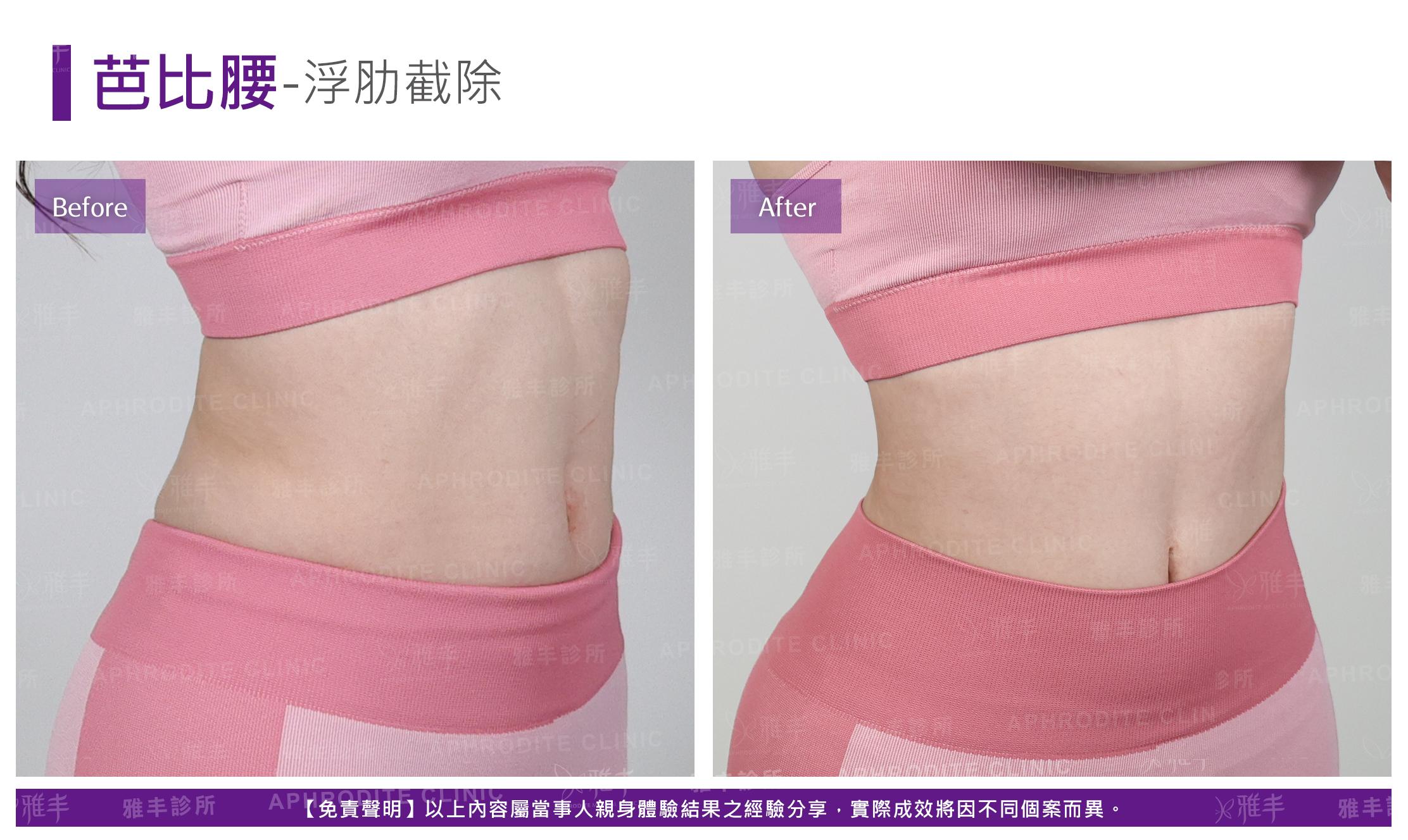 芭比腰-case4-R45.jpg