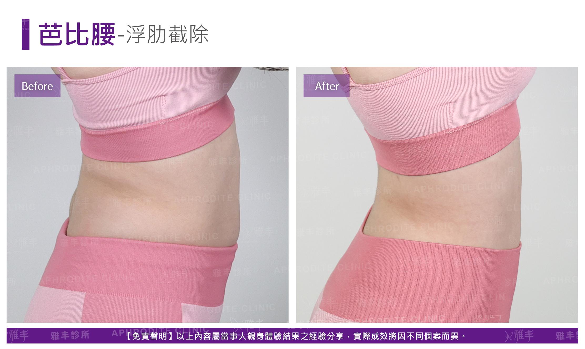芭比腰-case4-R90.jpg
