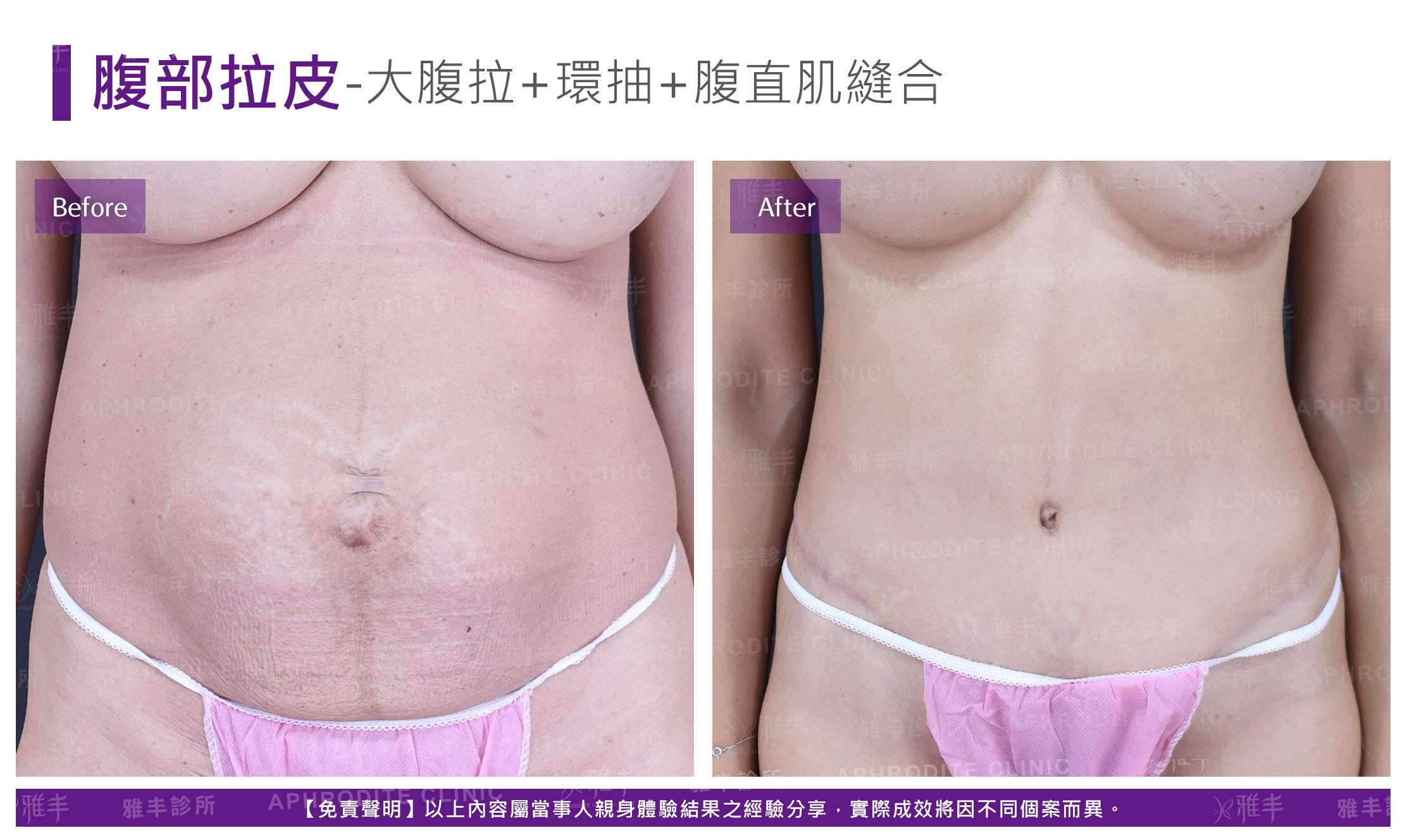 腹部拉皮-case5-F.jpg