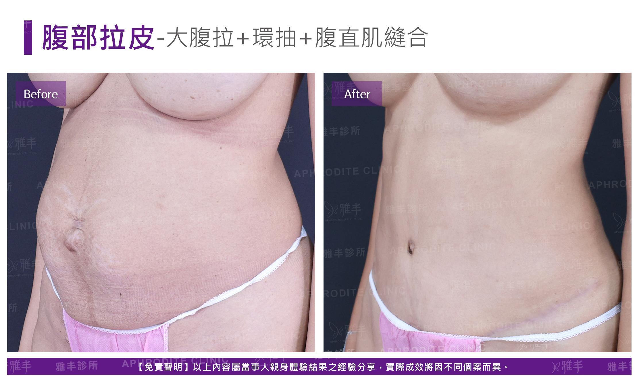 腹部拉皮-case5-L45.jpg