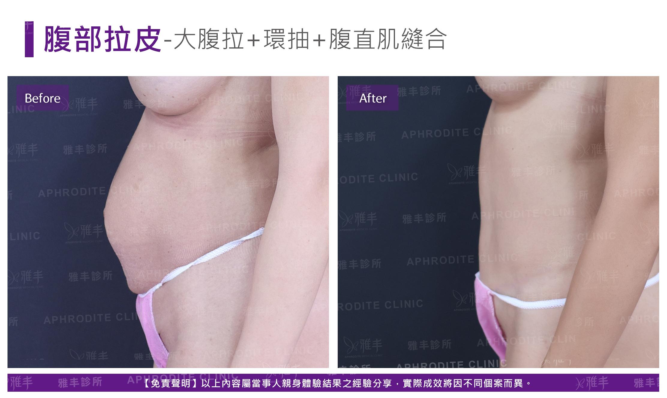 腹部拉皮-case5-L90.jpg