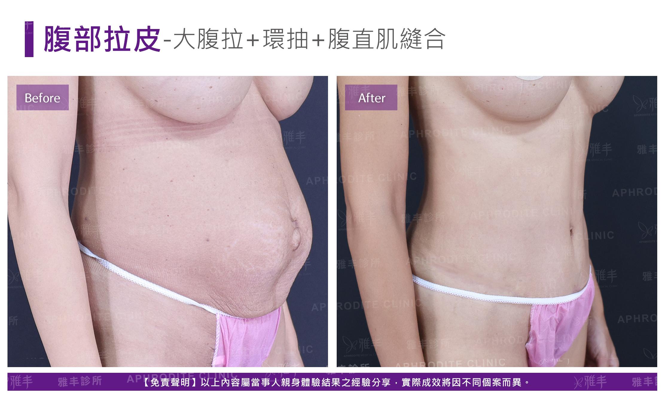 腹部拉皮-case5-R45.jpg