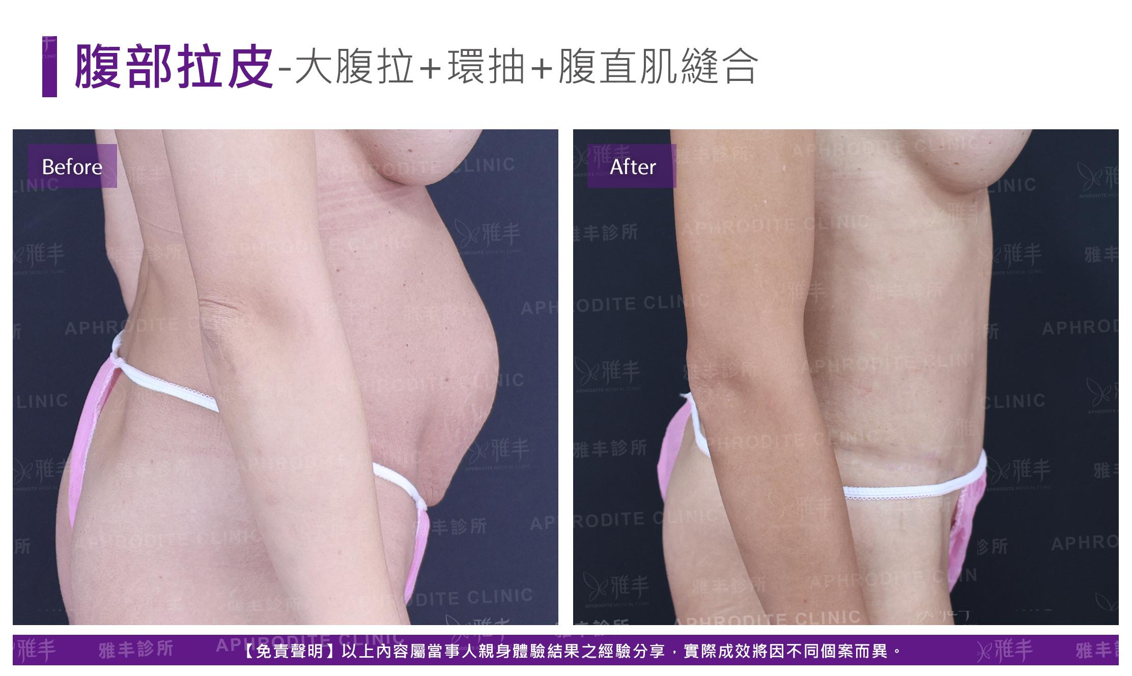 腹部拉皮-case5-R90.jpg