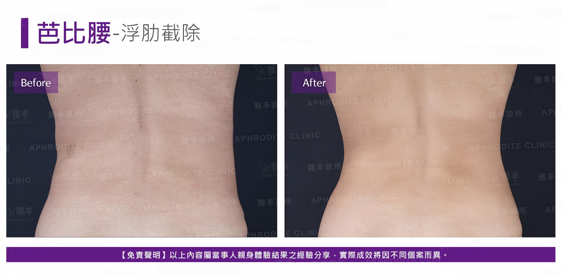 芭比腰-case6-B.jpg
