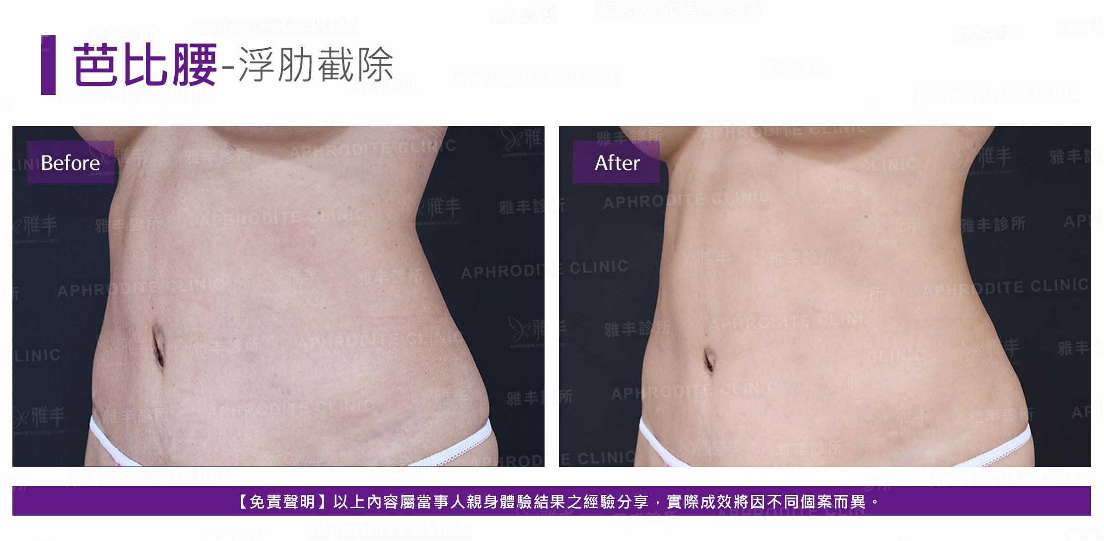 芭比腰-case6-L45.jpg