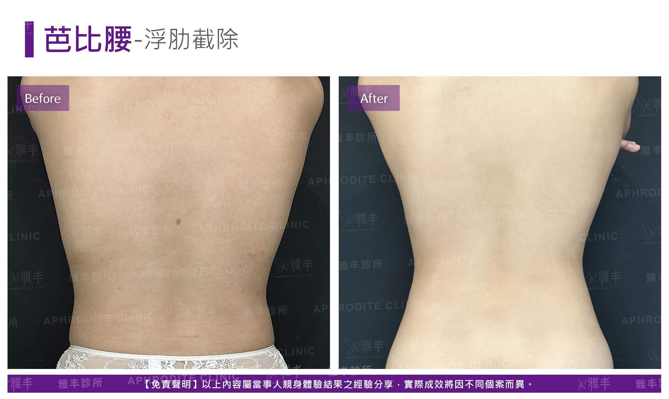 眼袋內開-case7-B.jpg