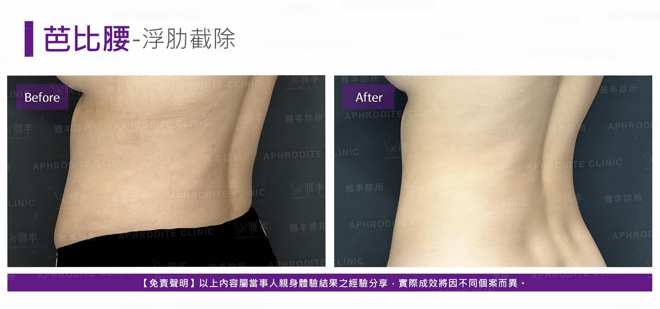 眼袋內開-case7-BL45.jpg