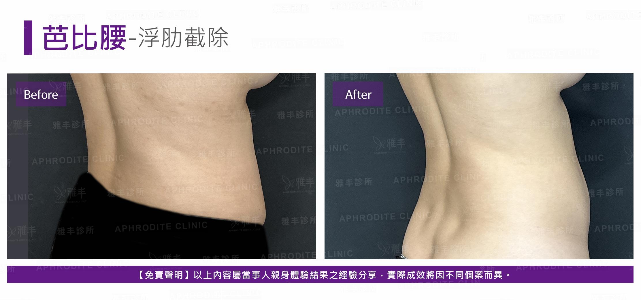 眼袋內開-case7-BR45.jpg