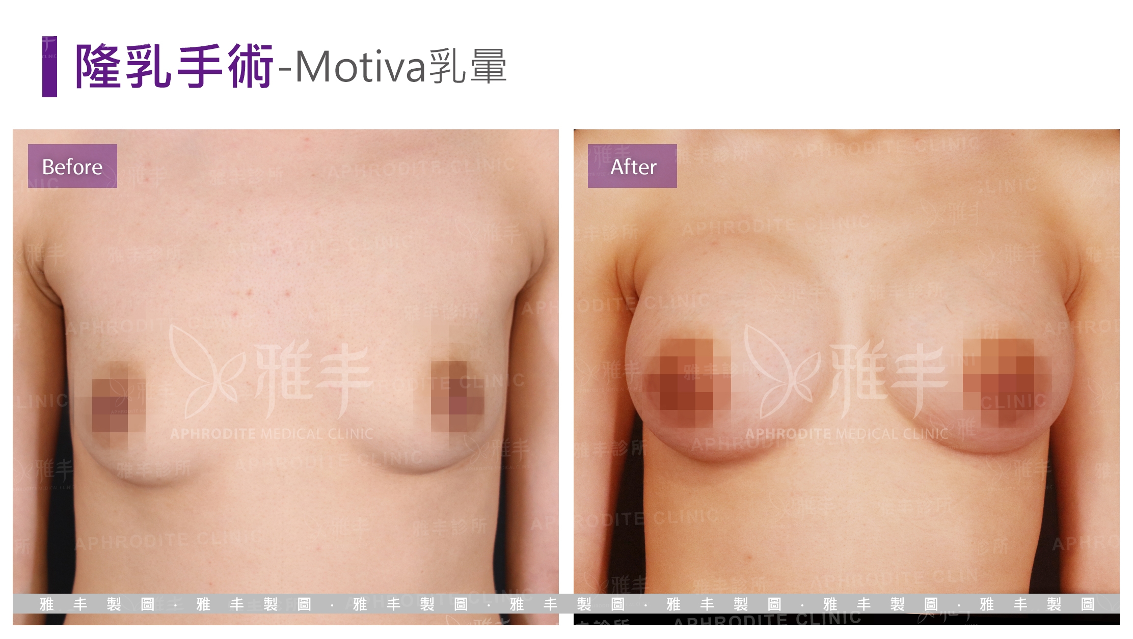 隆乳手術-Motiva乳暈(Case1)