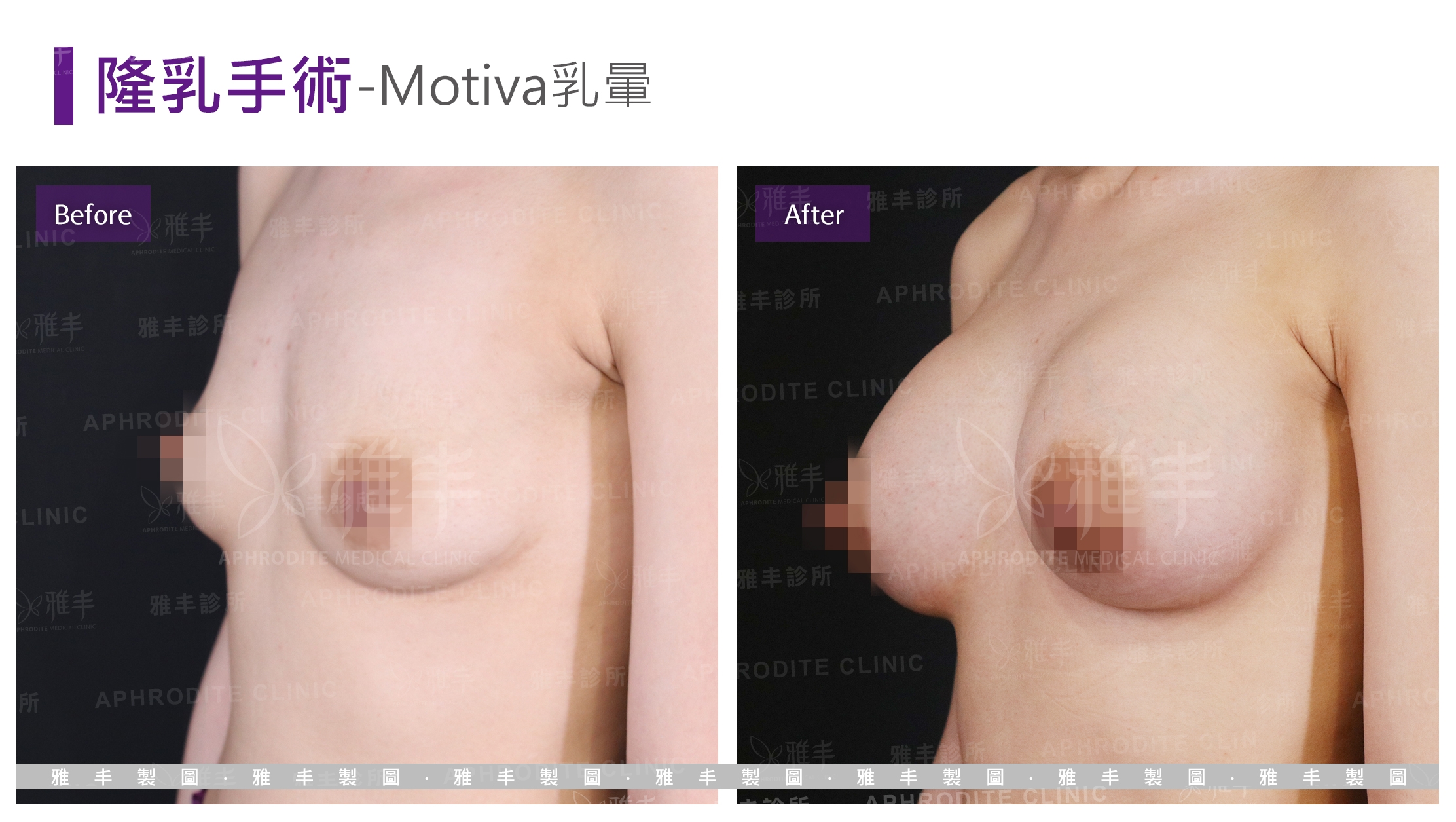 隆乳手術-Motiva乳暈(Case1-L45)