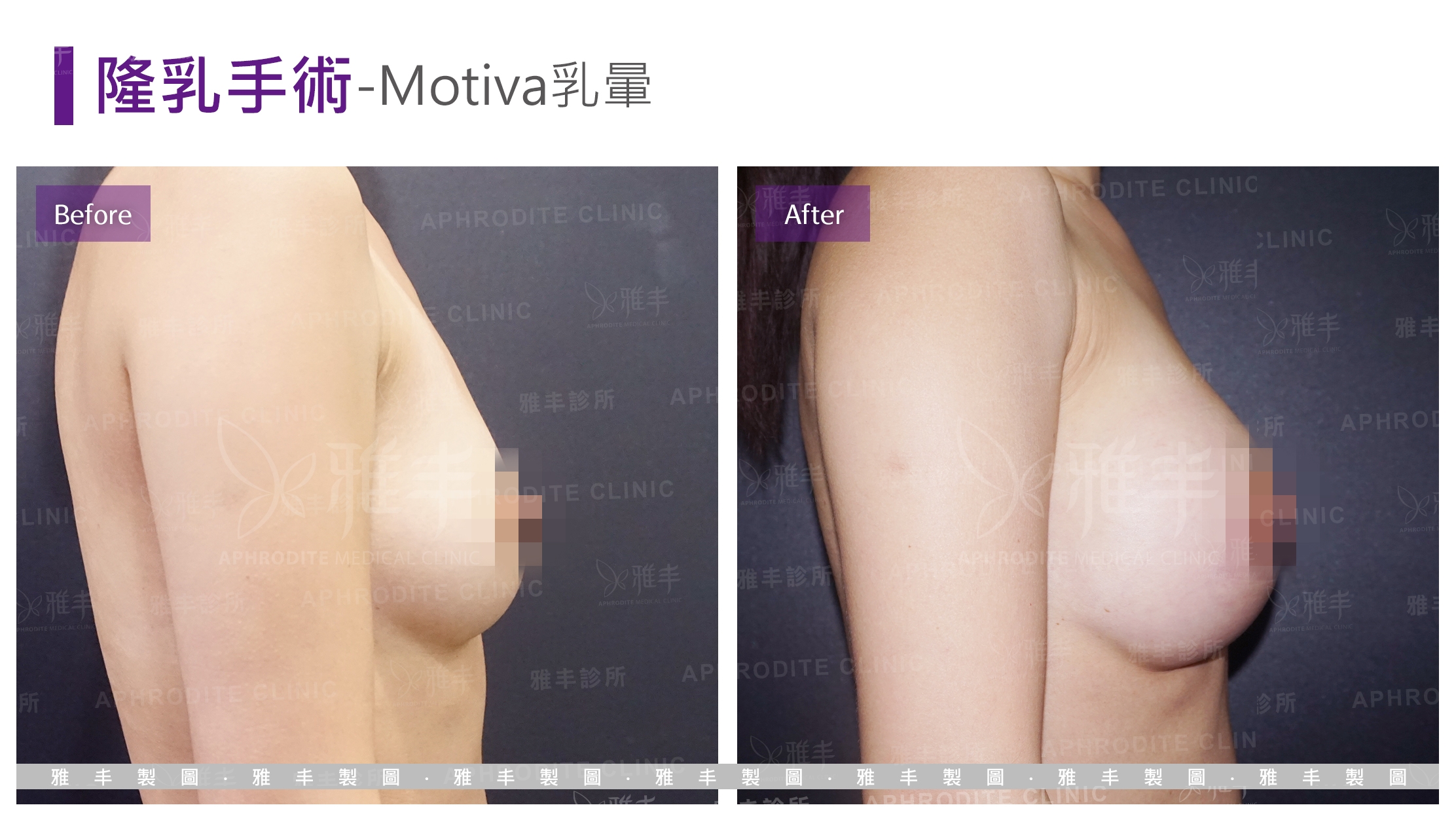 隆乳手術-Motiva乳暈(Case10-R90)
