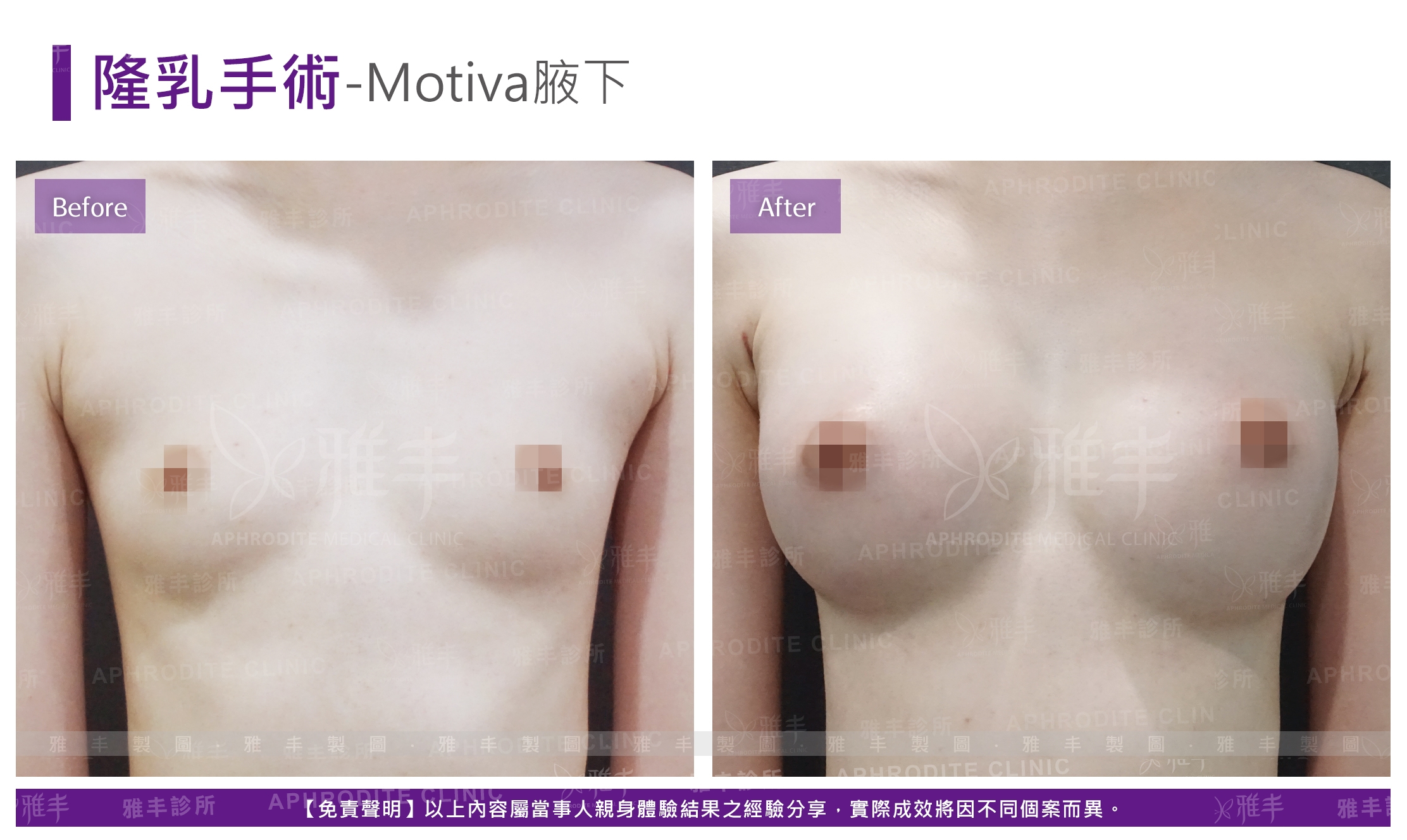 隆乳手術-Motiva腋下(Case11)