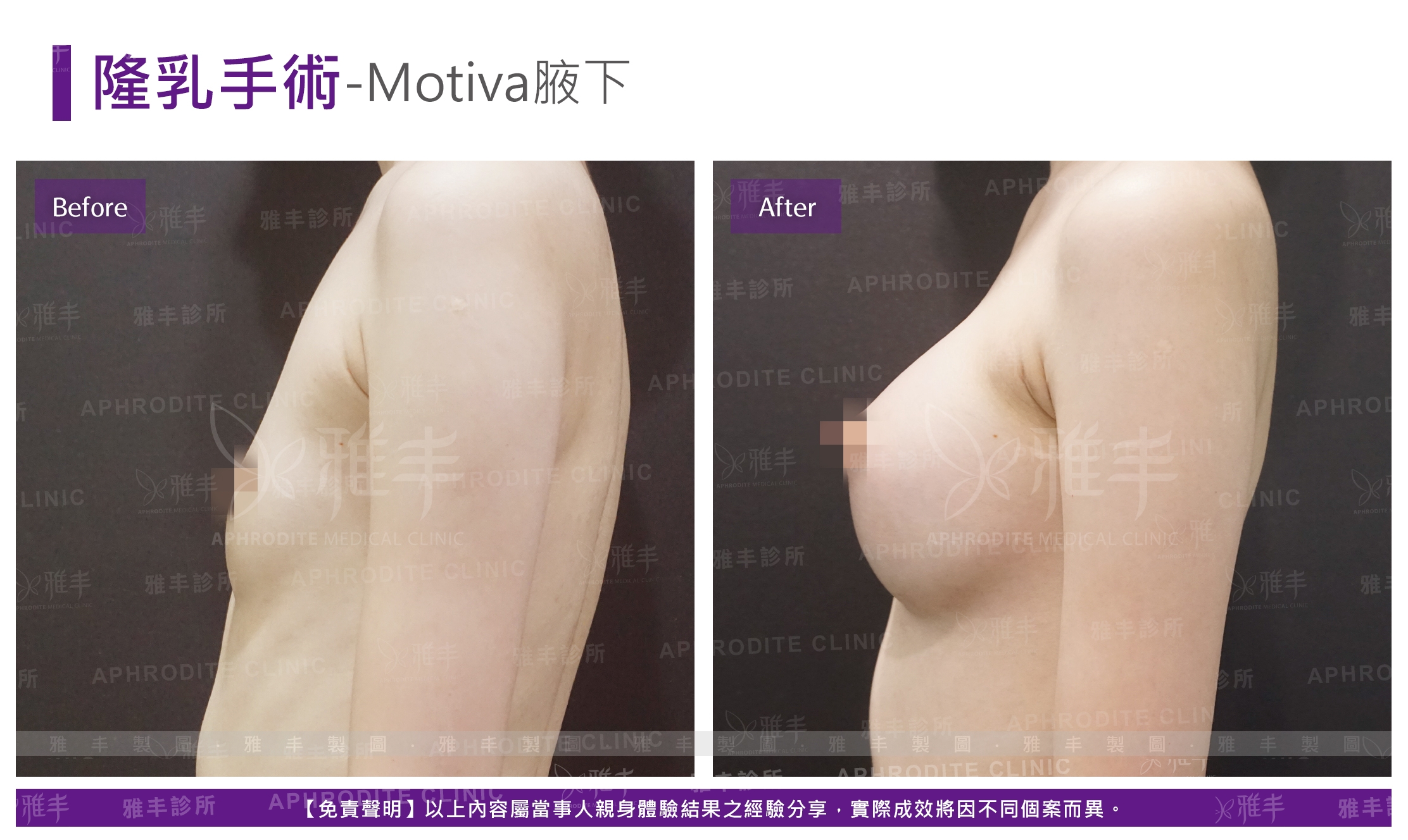 隆乳手術-Motiva腋下(Case11-L90)