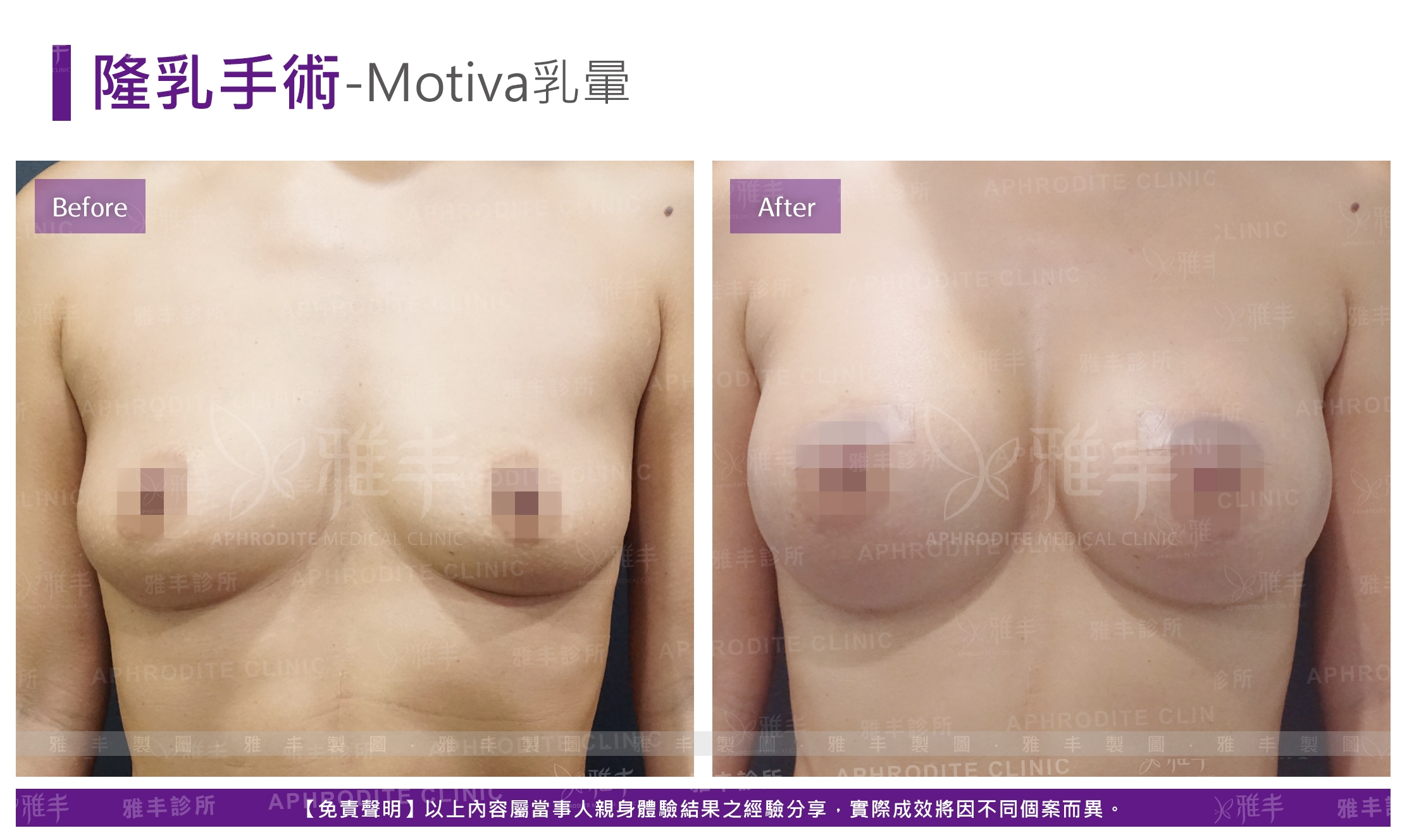 隆乳手術-Motiva乳暈(Case12)