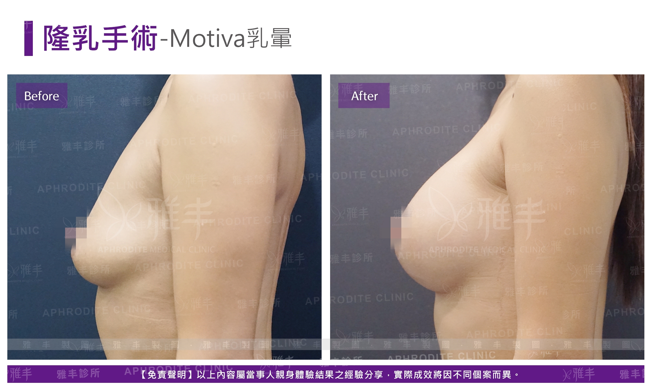 隆乳手術-Motiva乳暈(Case12-L90)