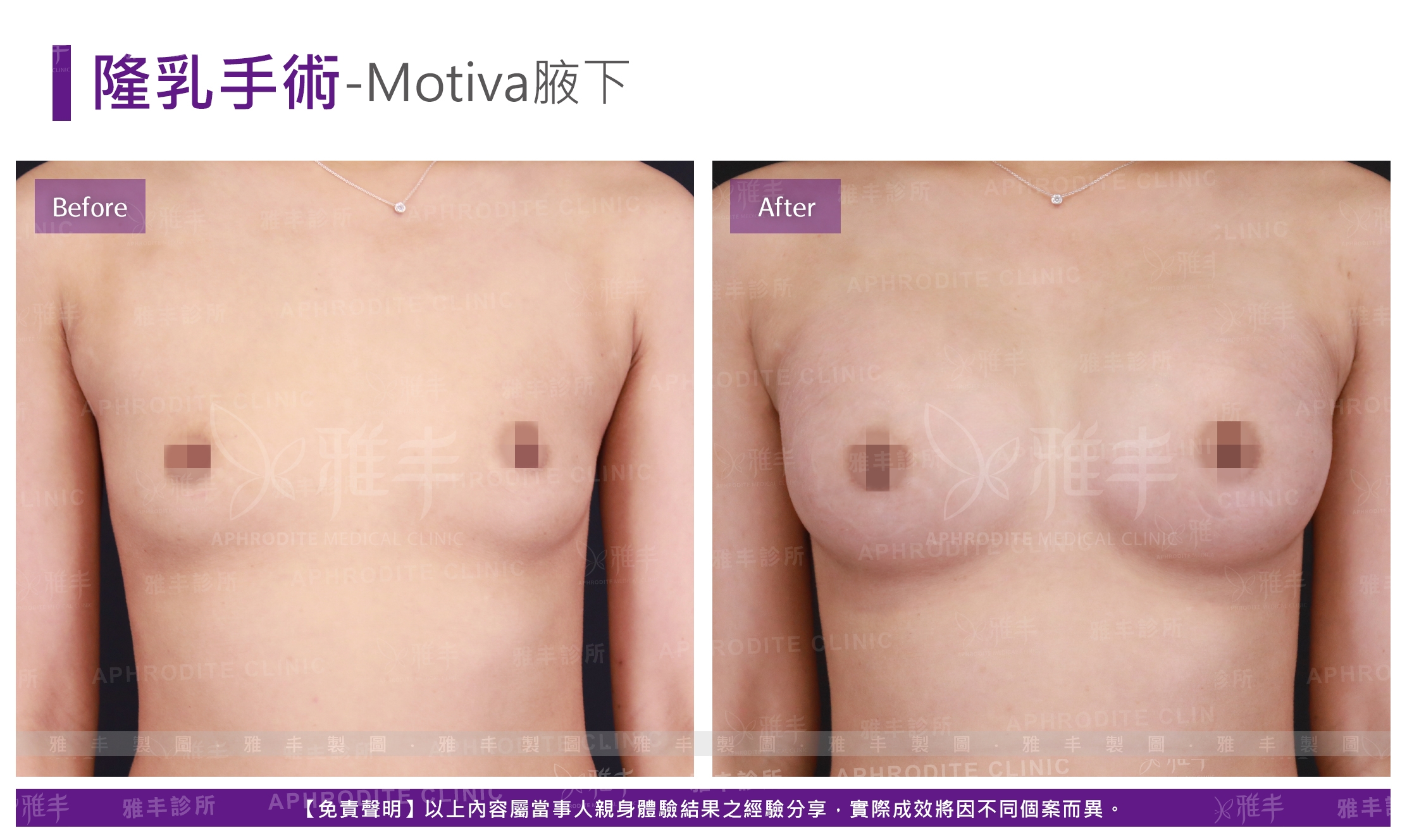 隆乳手術-Motiva腋下(Case13)