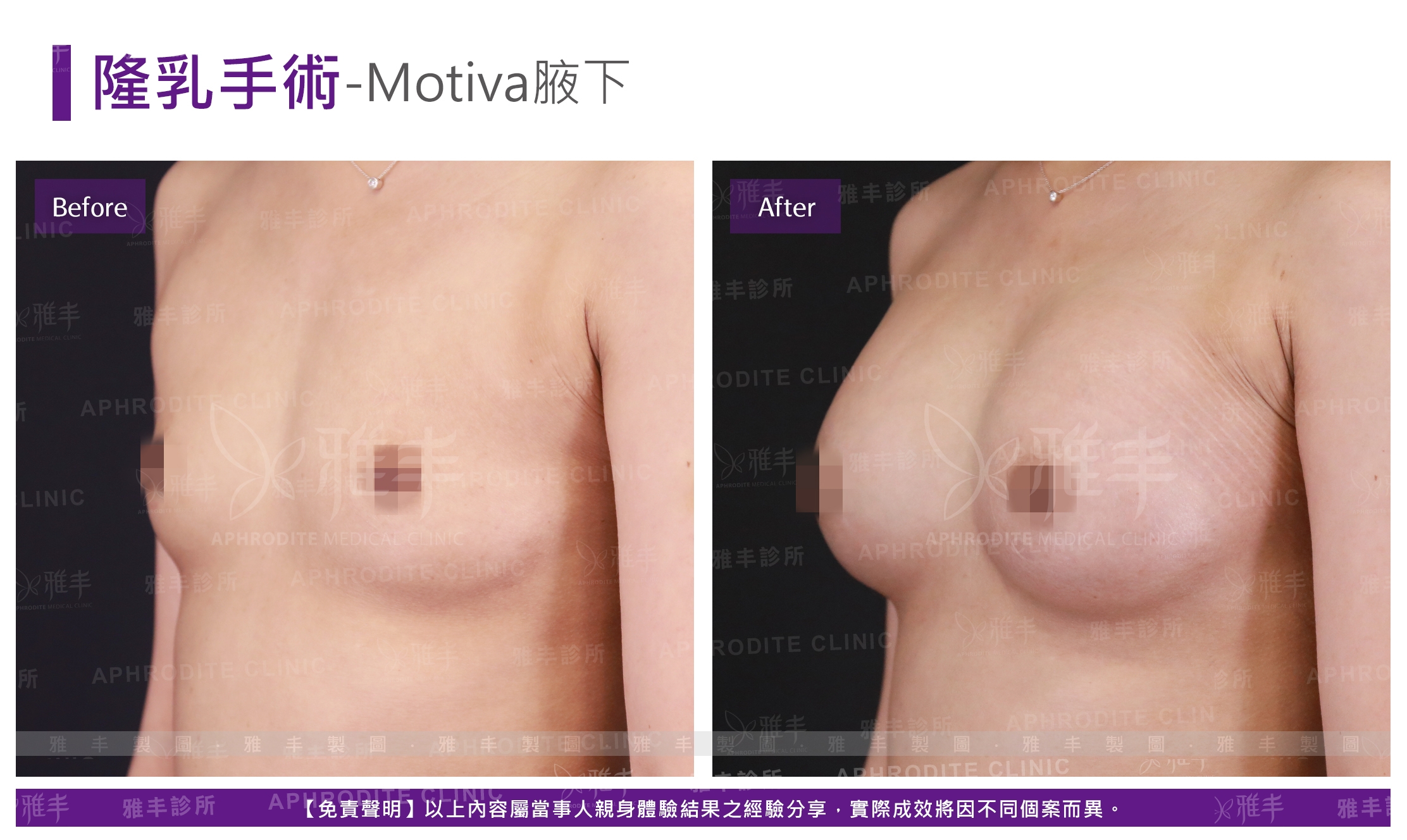 隆乳手術-Motiva腋下(Case13-L45)