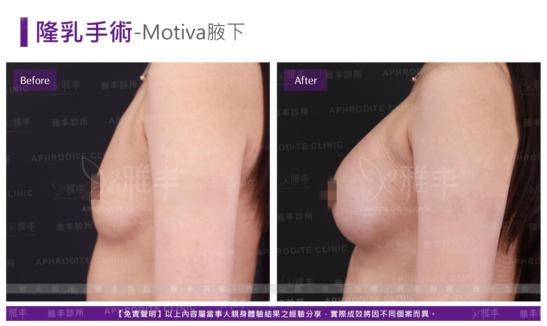 隆乳手術-Motiva腋下(Case13-R90)