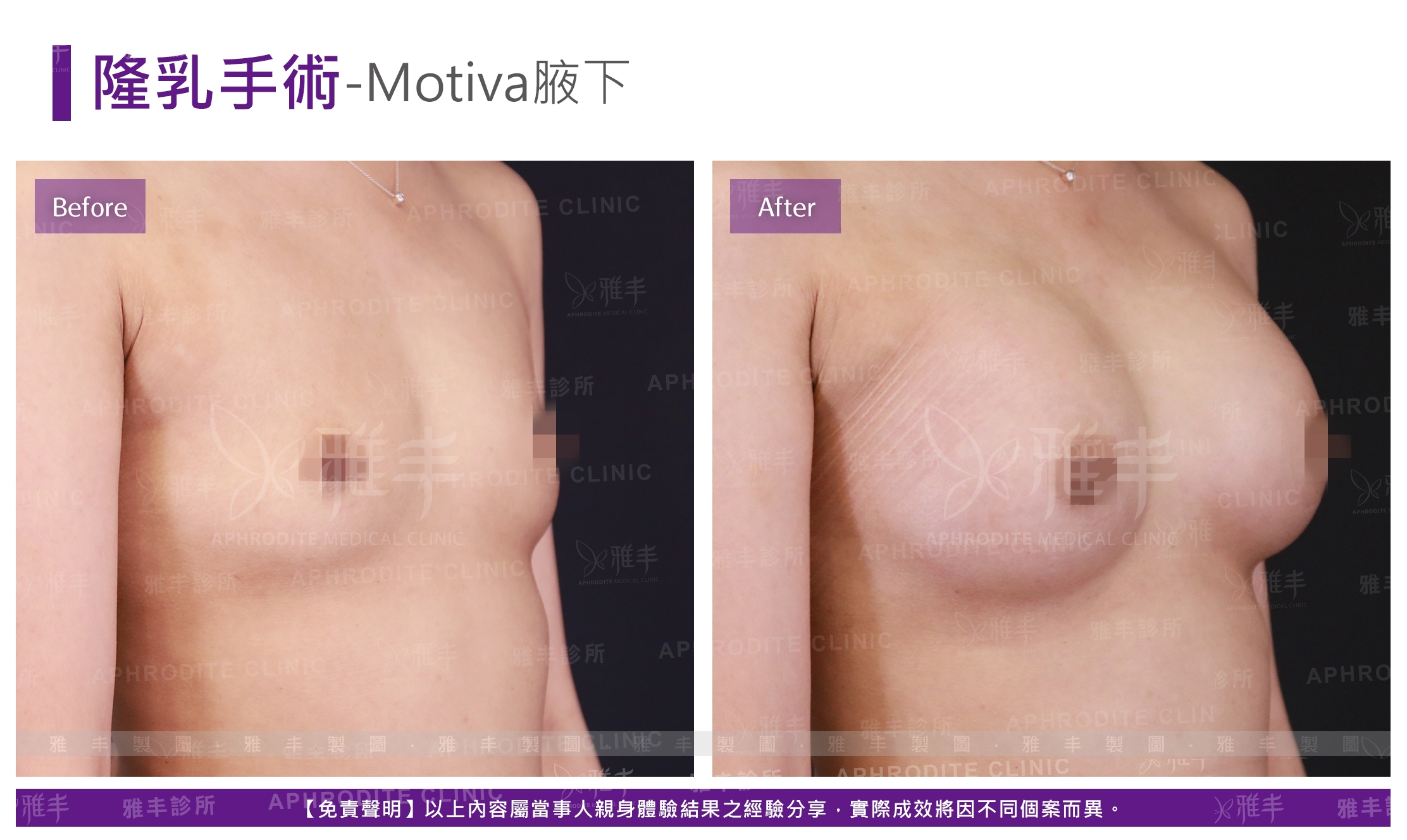 隆乳手術-Motiva腋下(Case13-R45)