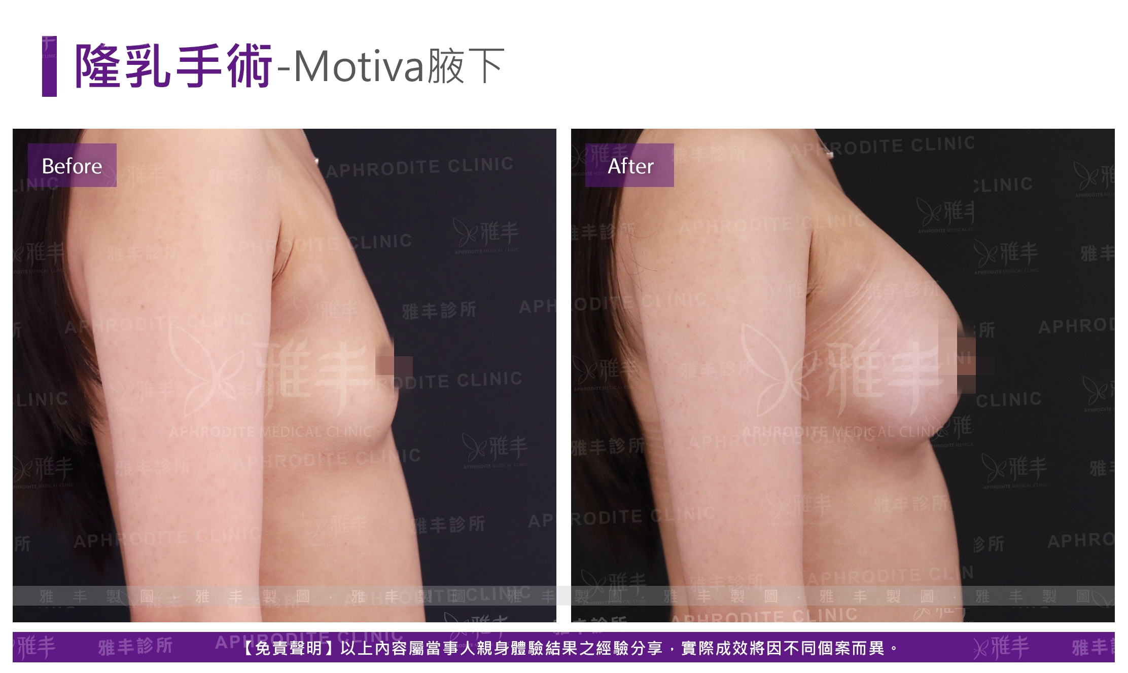隆乳手術-Motiva腋下(Case13-R90)