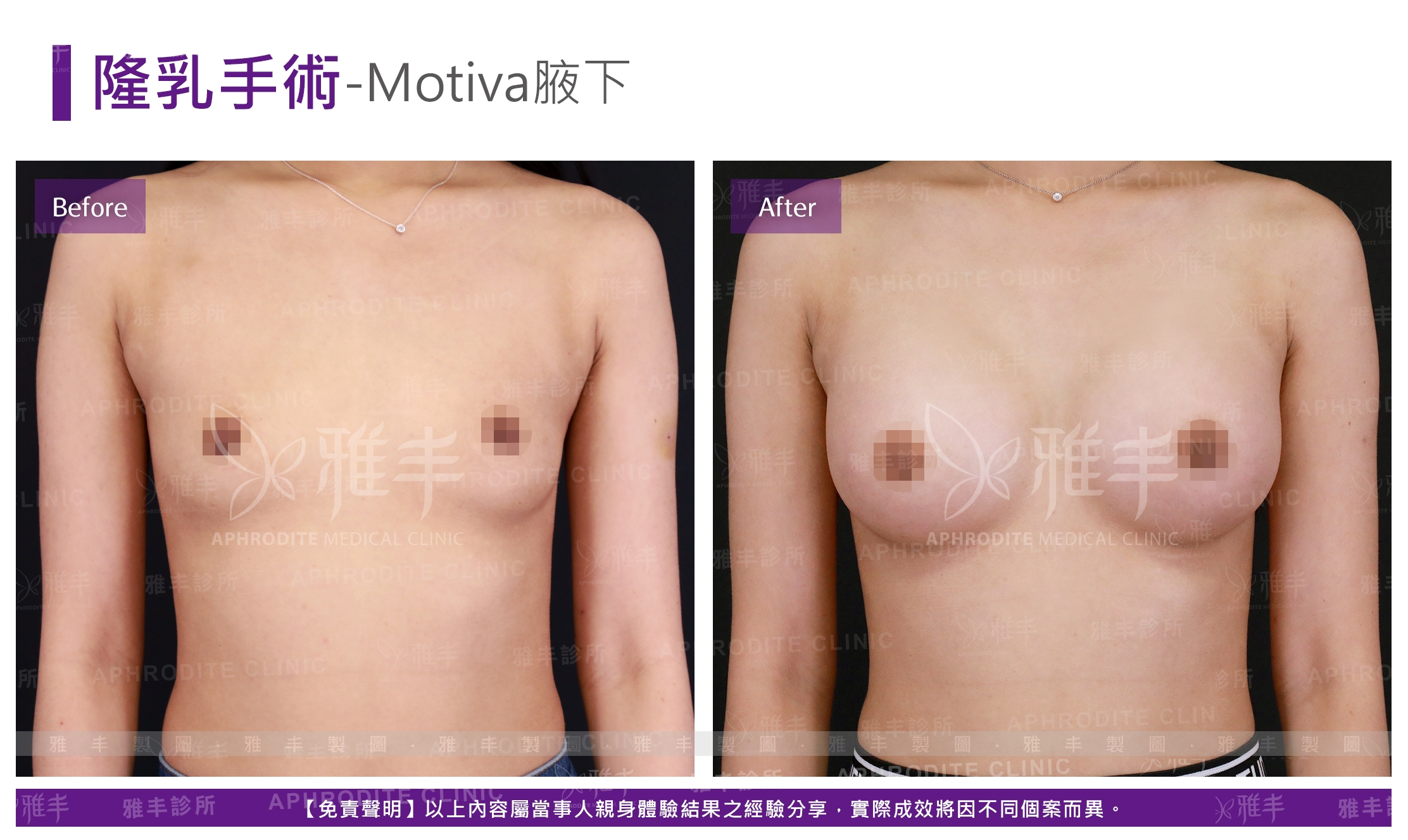隆乳手術-Motiva腋下(Case14)
