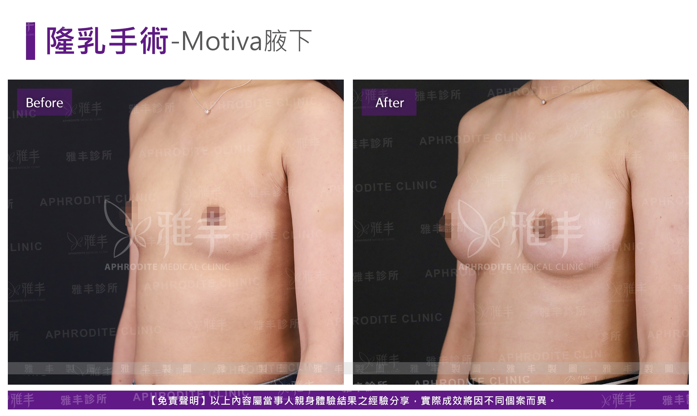 隆乳手術-Motiva腋下(Case14-L45)