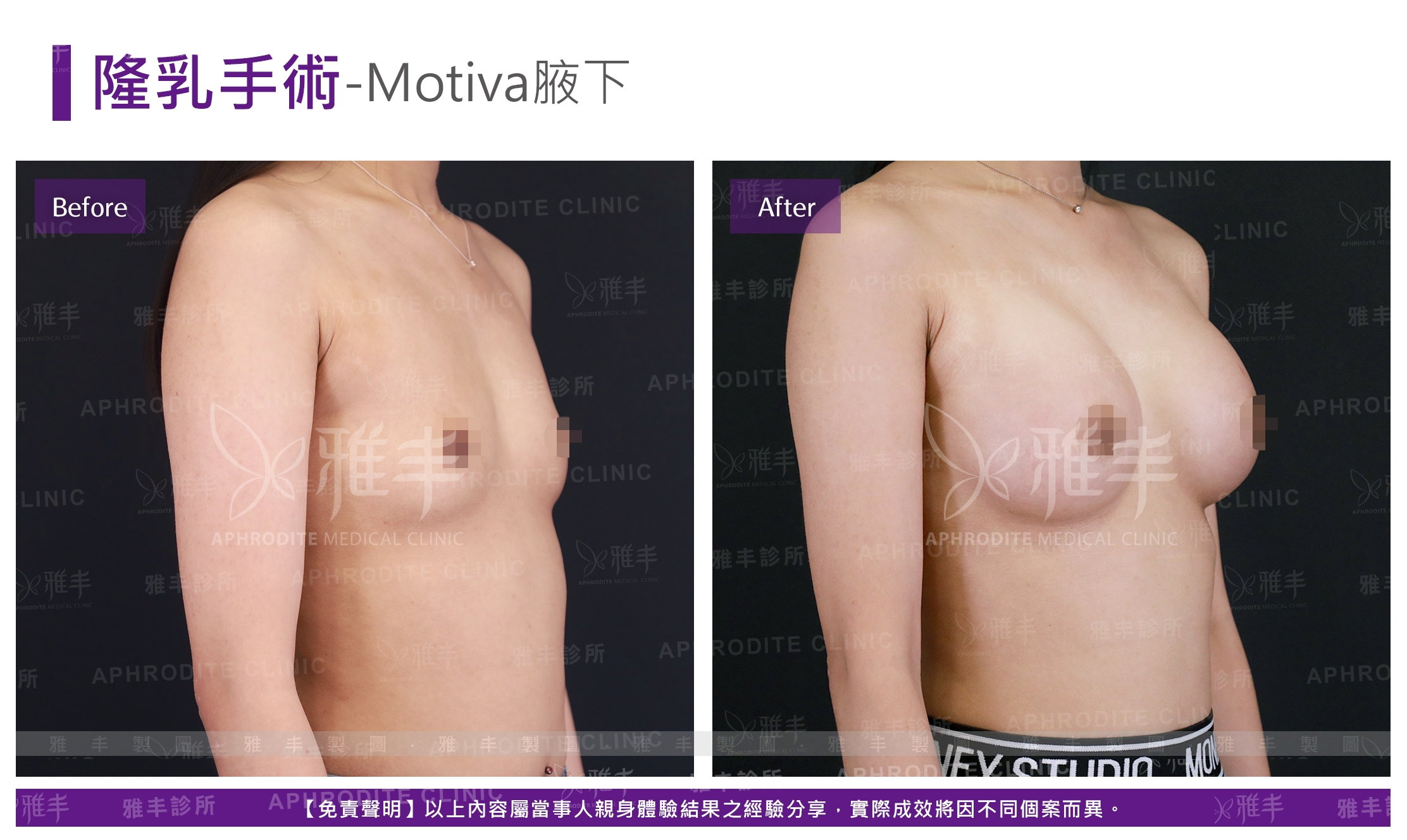 隆乳手術-Motiva腋下(Case14-R45)