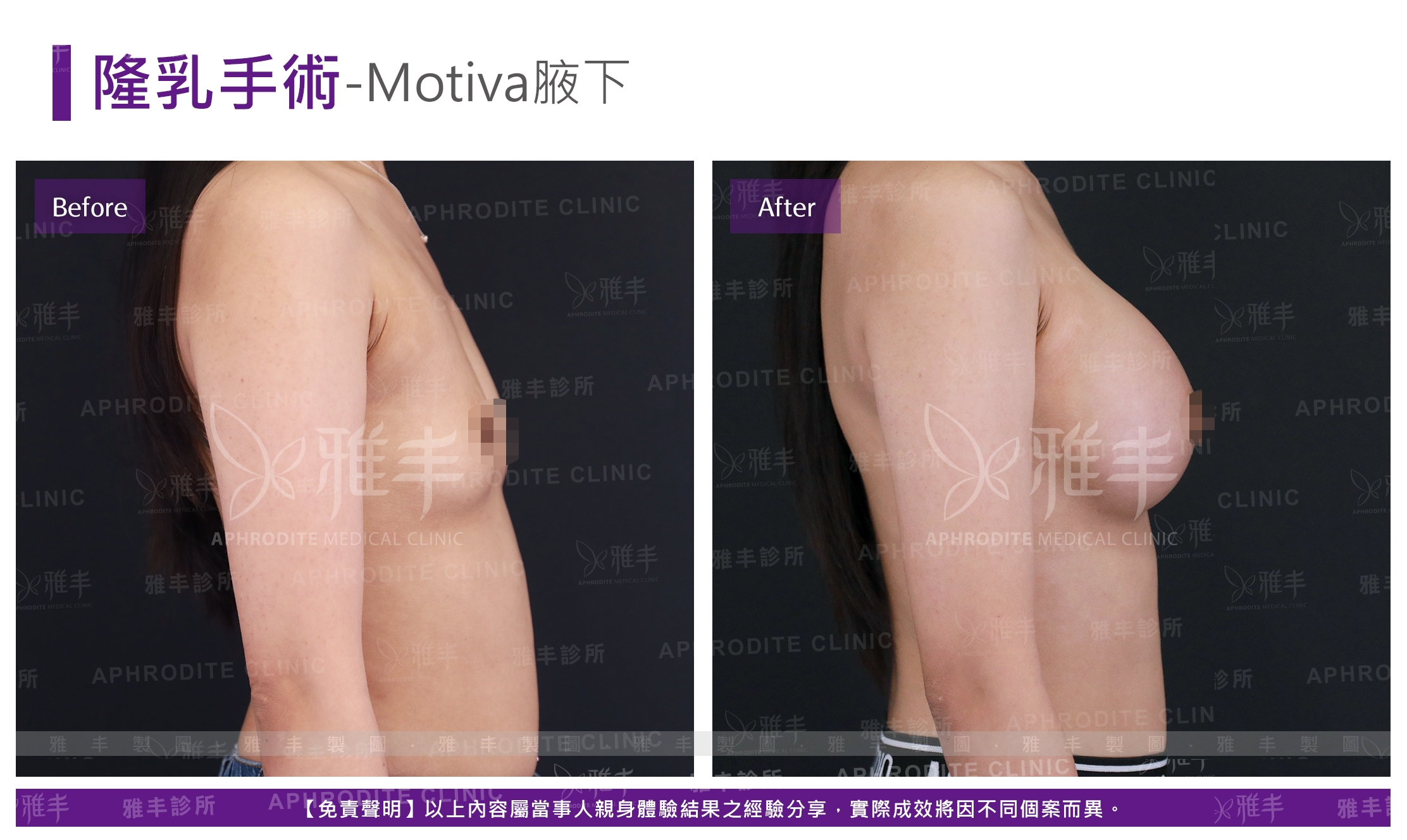 隆乳手術-Motiva腋下(Case14-R90)