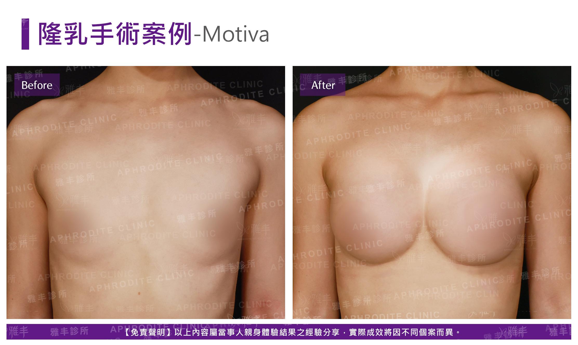 隆乳手術-Motiva-case15-F