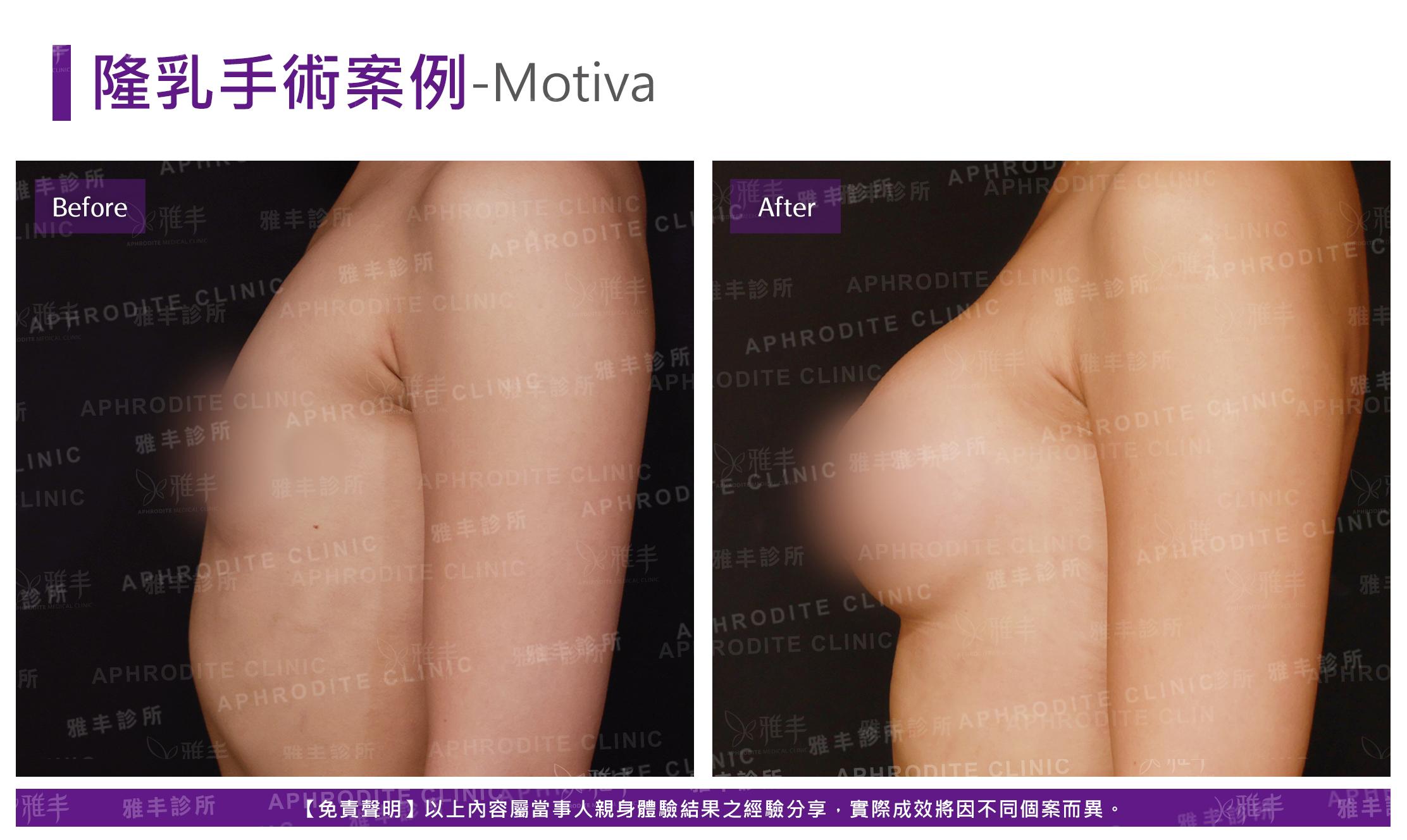 隆乳手術-Motiva-case15-L90