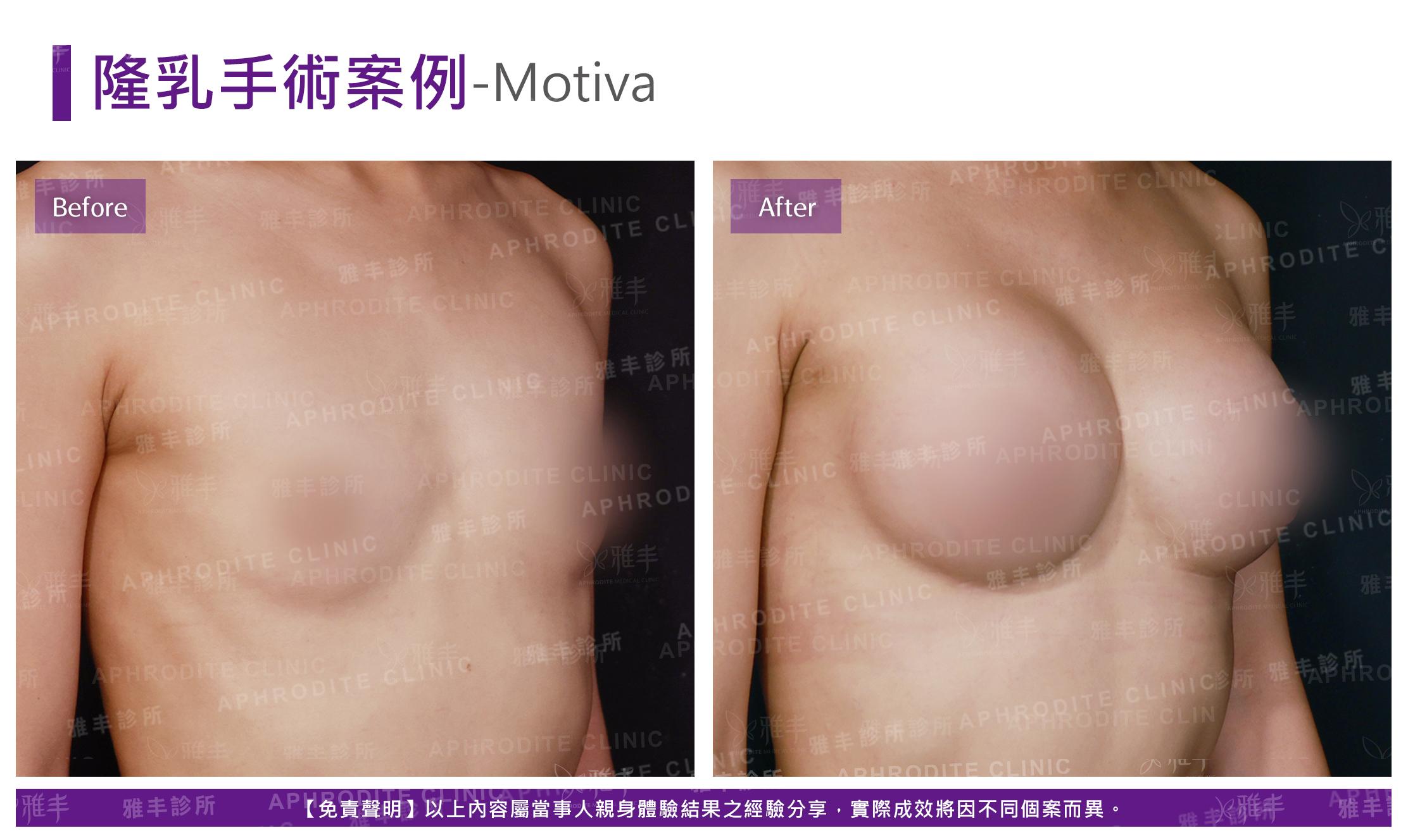 隆乳手術-Motiva-case15-R45