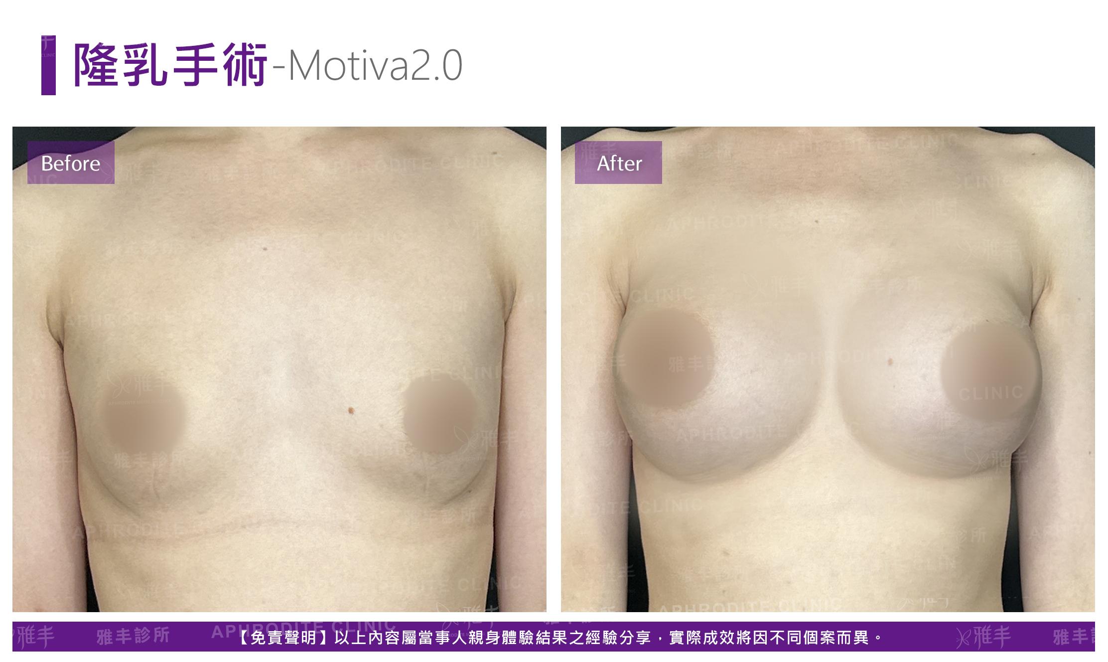 隆乳手術-case18-F.jpg