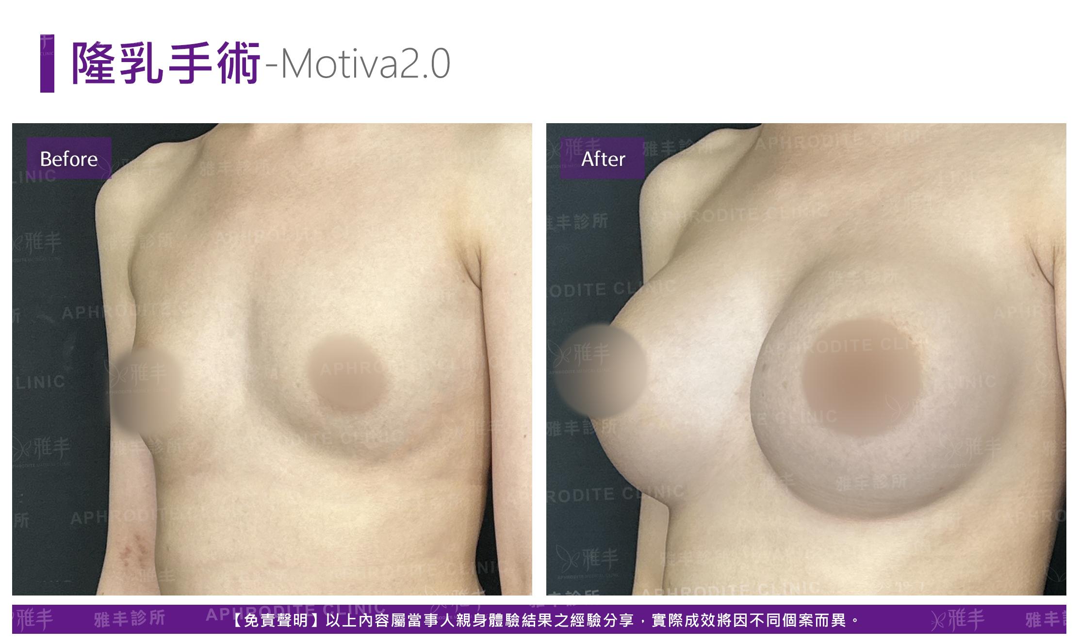 隆乳手術-case18-L45