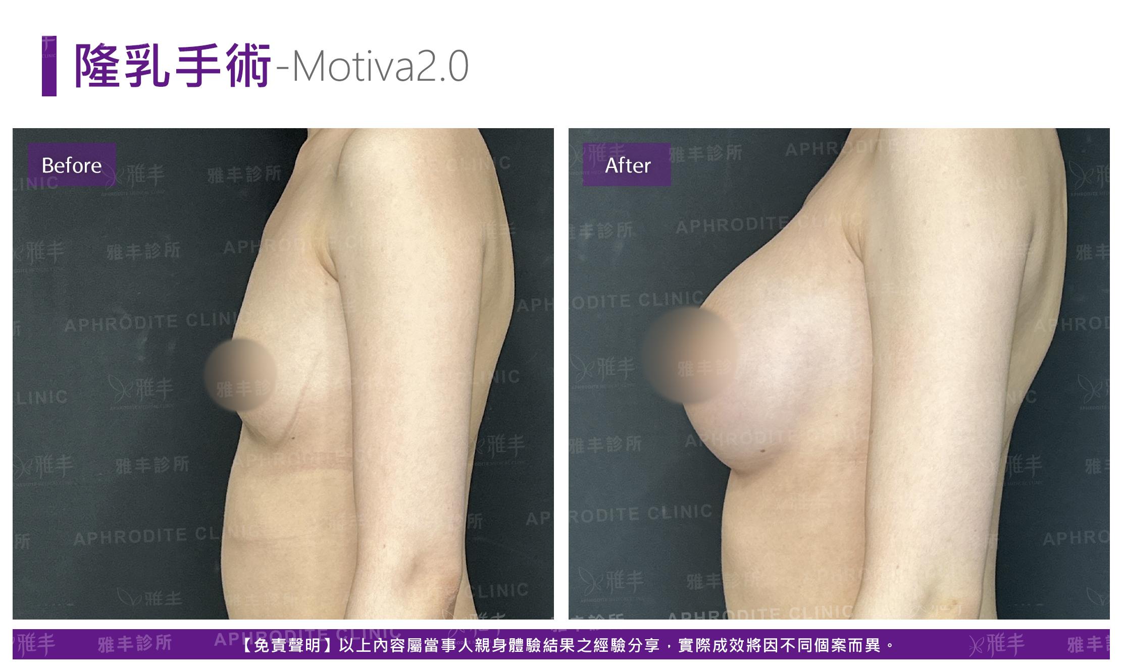 隆乳手術-case18-L90.jpg