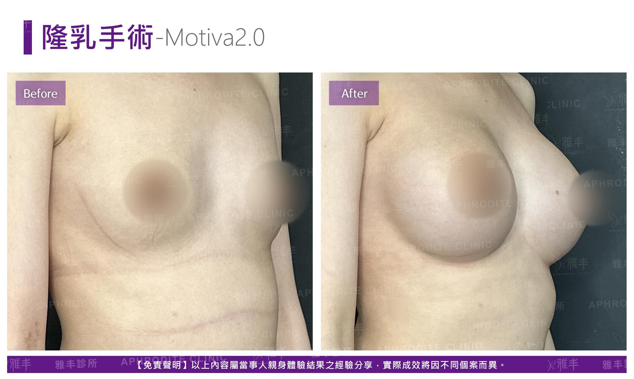 隆乳手術-case18-R45.jpg