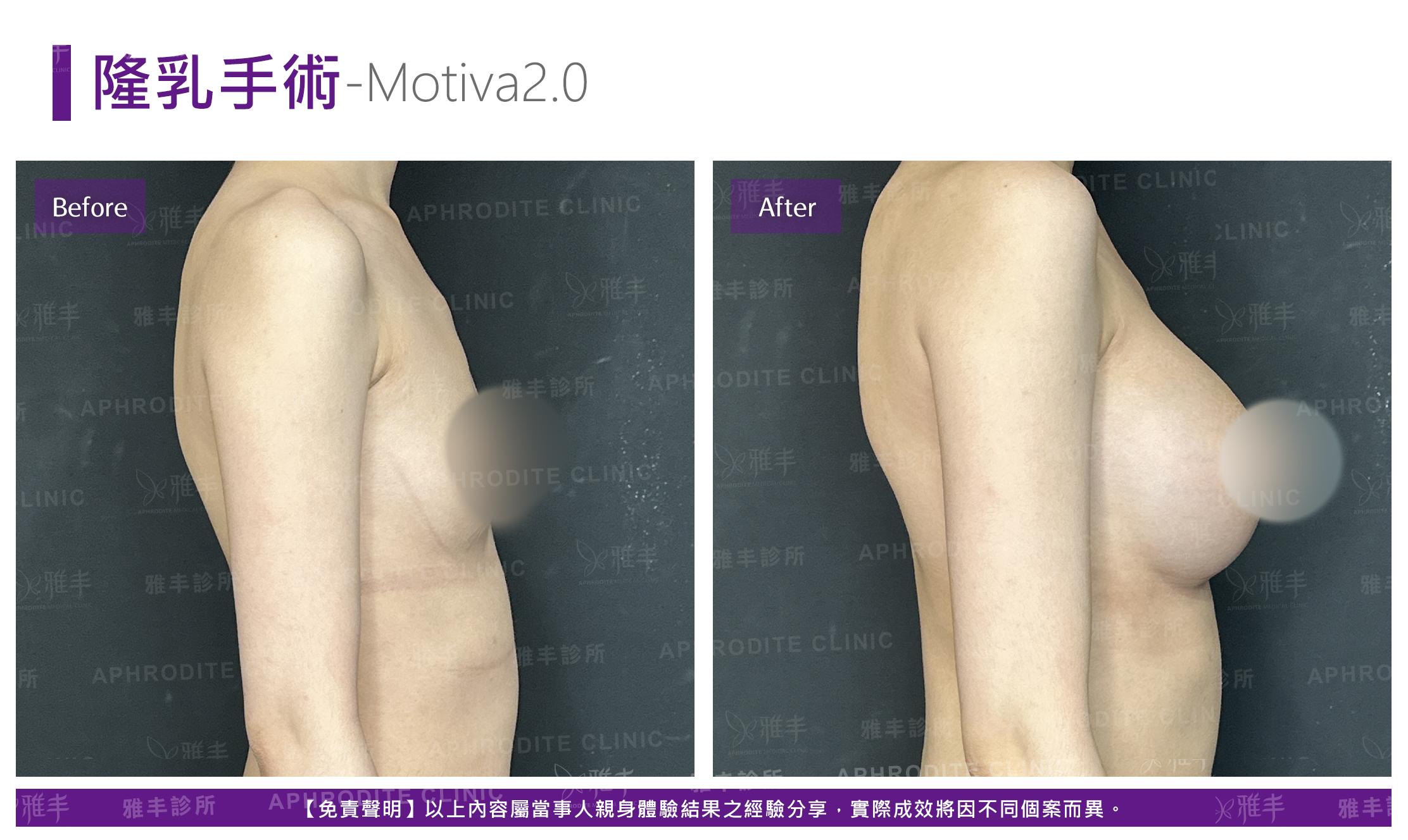 隆乳手術-case18-R90.jpg