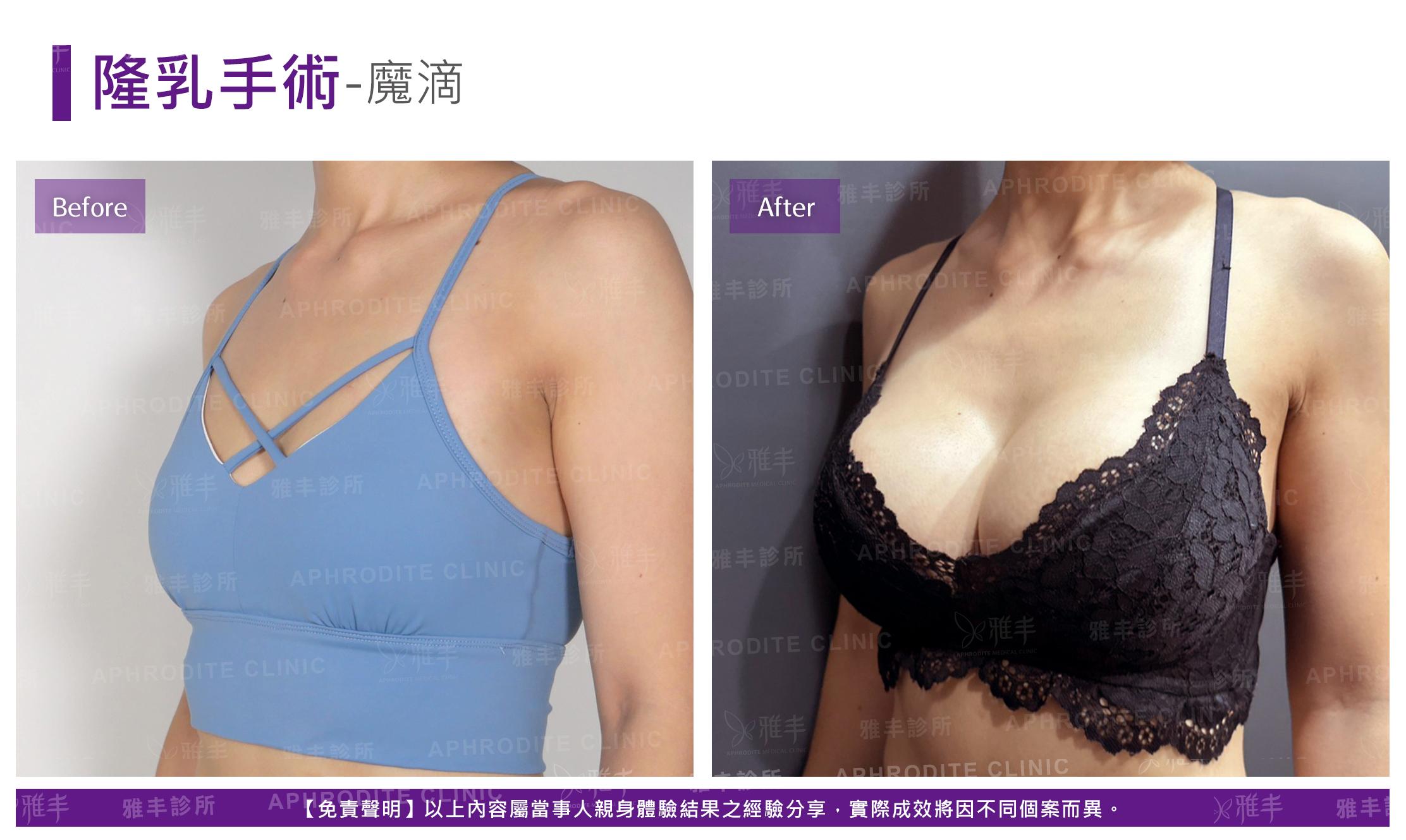 隆乳手術-case19-R45.jpg