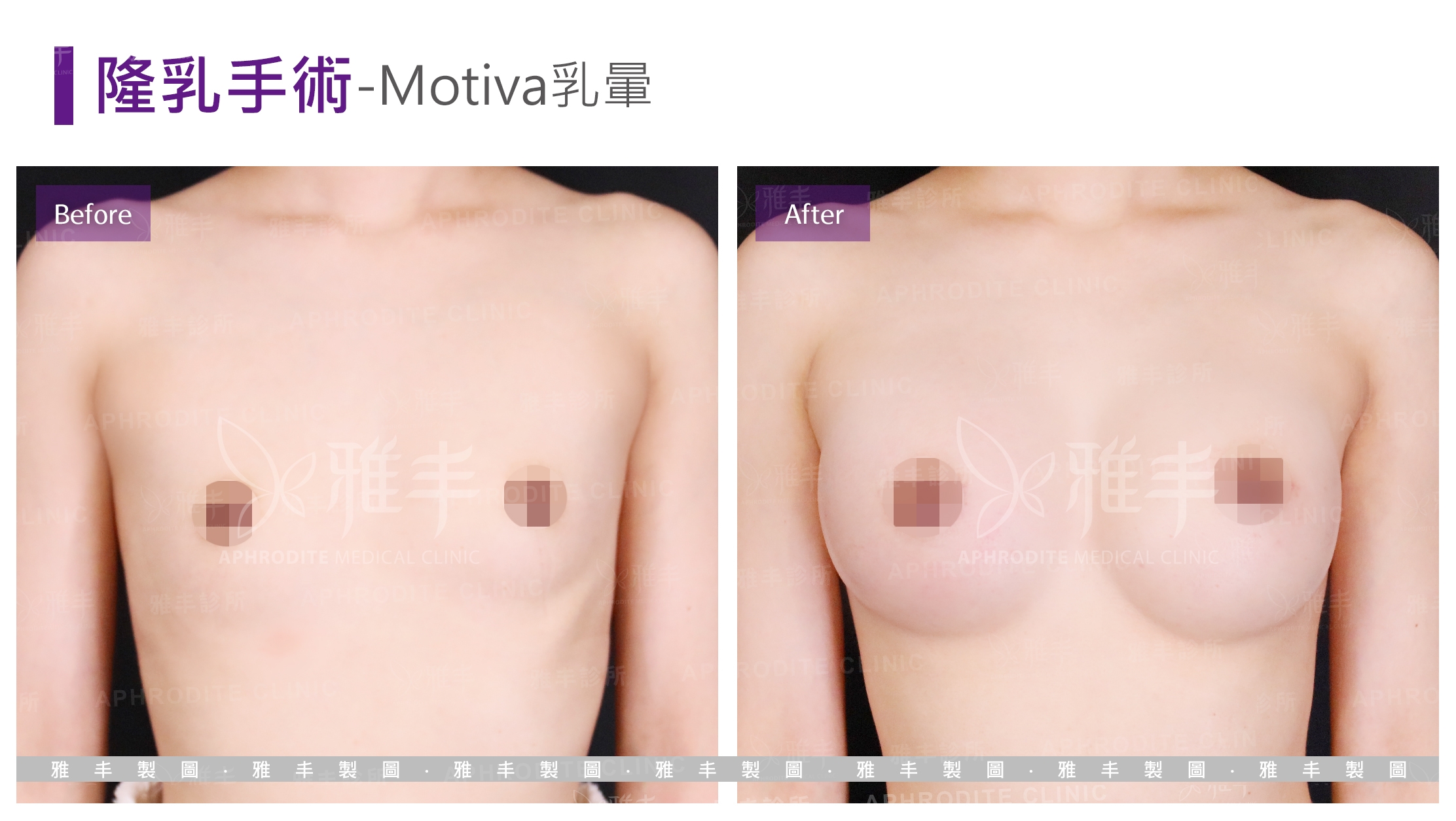 隆乳手術-Motiva乳暈(Case2)