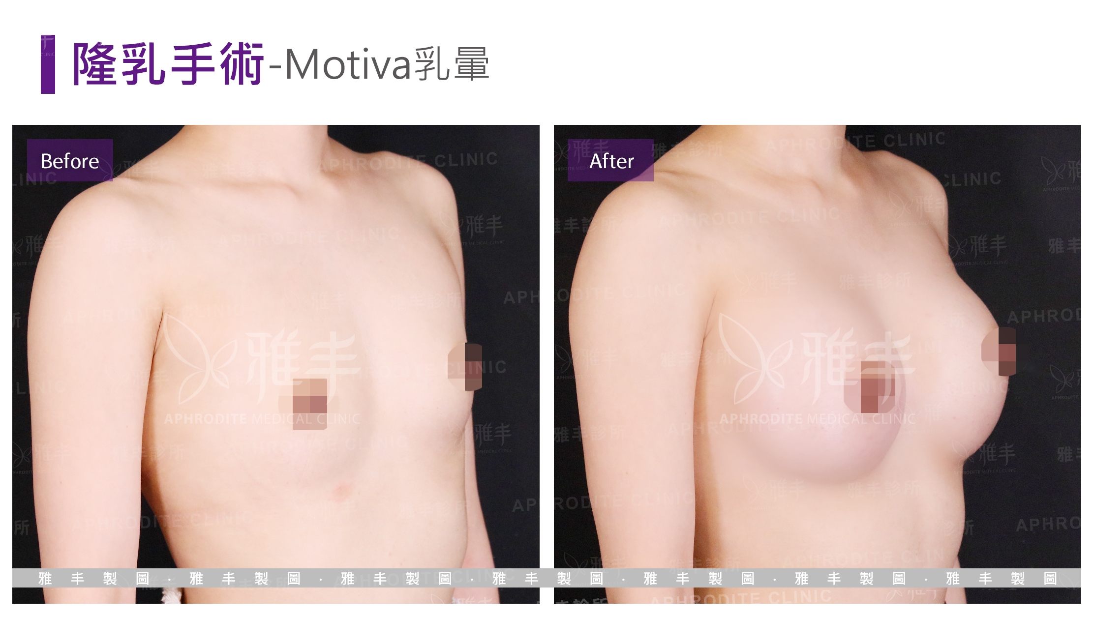 隆乳手術-Motiva乳暈(Case2-L45)