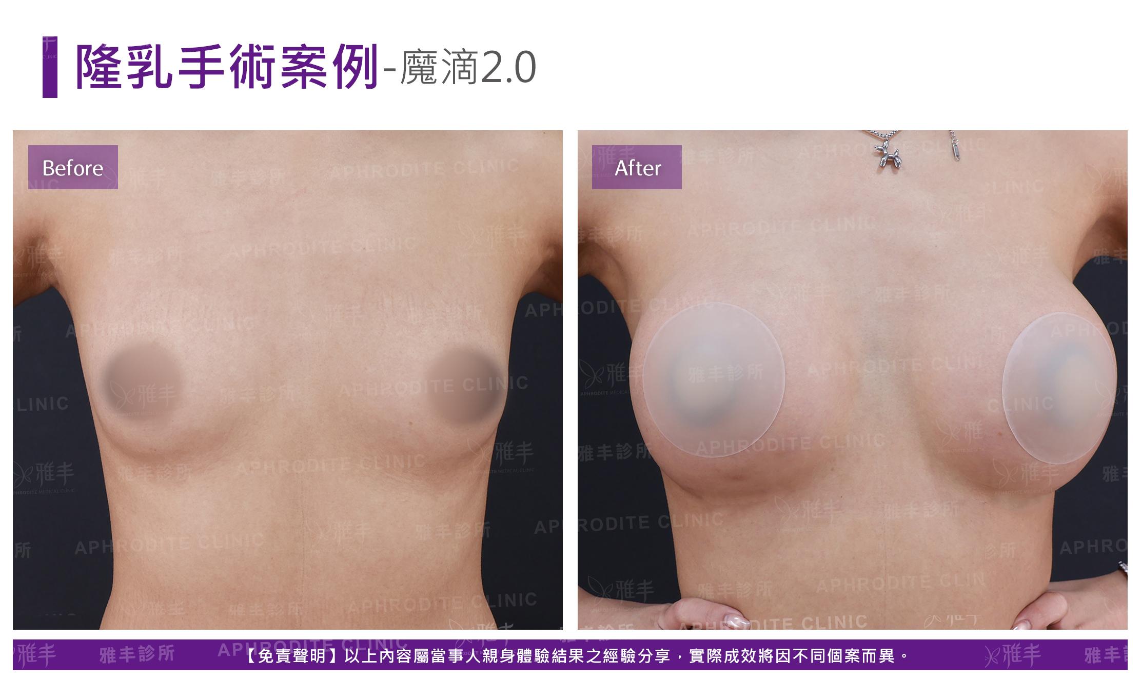 隆乳手術-case20-F.jpg