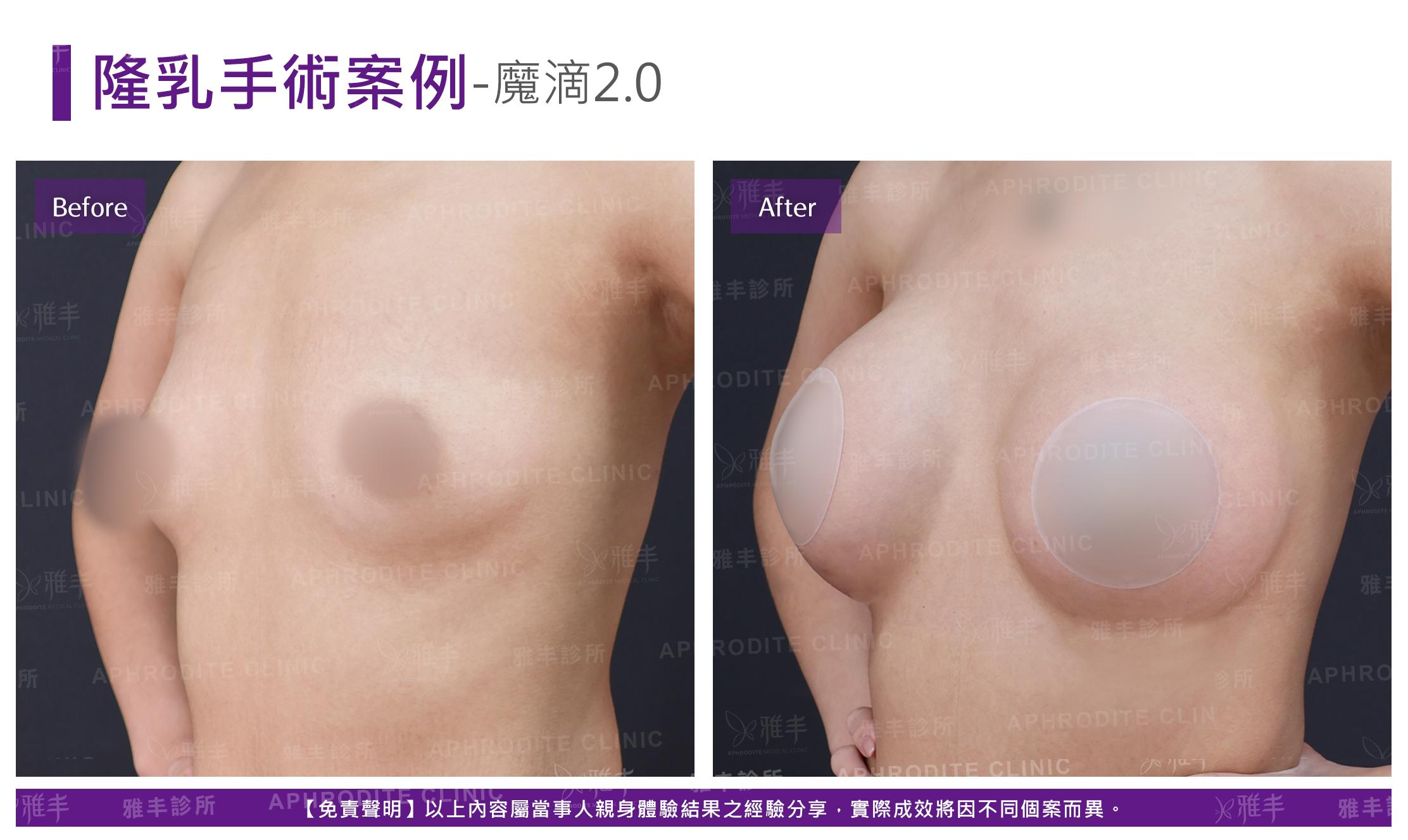 隆乳手術-case20-L45.jpg