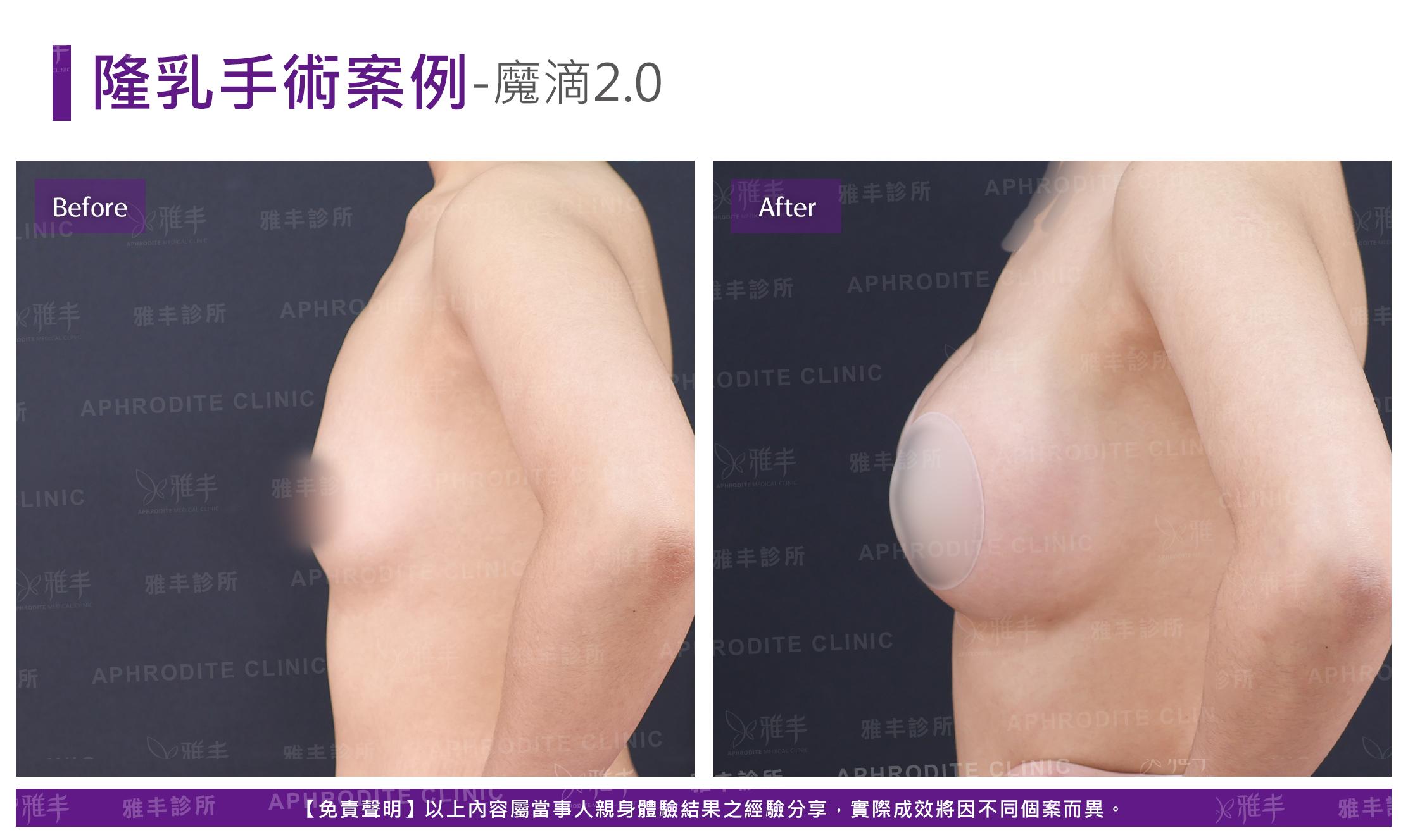 隆乳手術-case20-L90.jpg