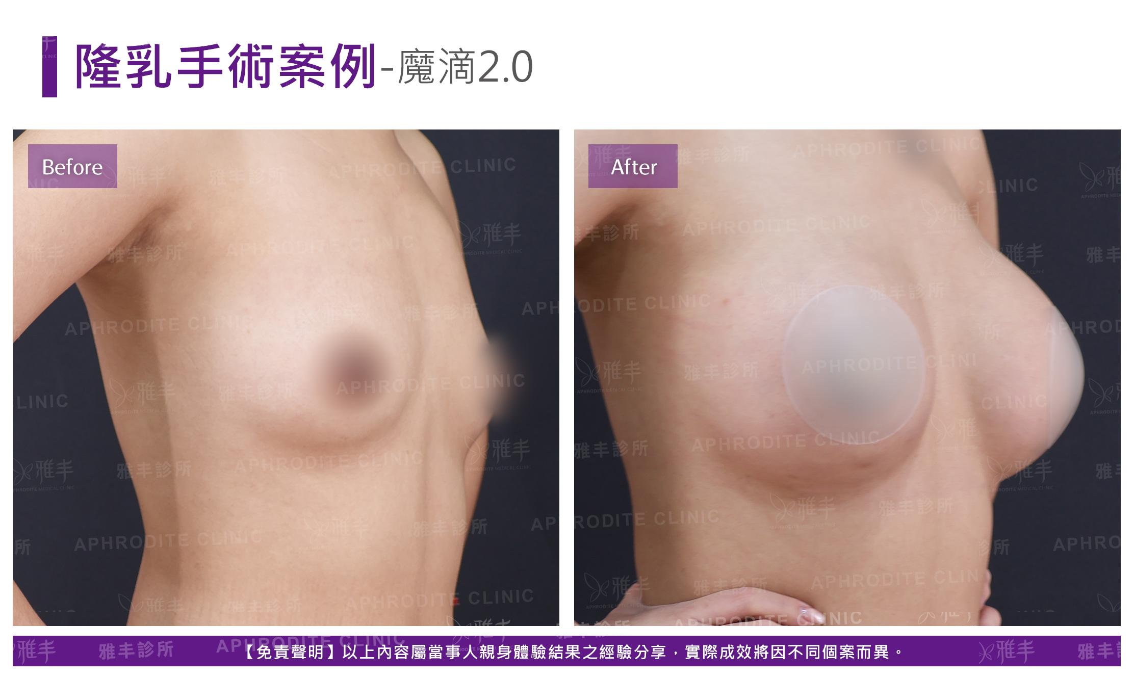 隆乳手術-case20-R45.jpg