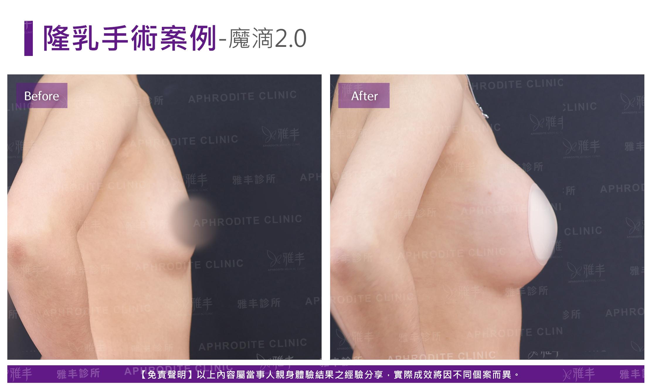 隆乳手術-case20-R90.jpg