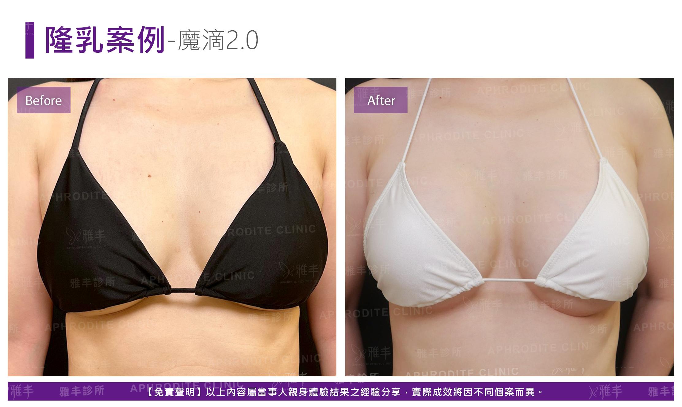 隆乳手術-case21-F.jpg